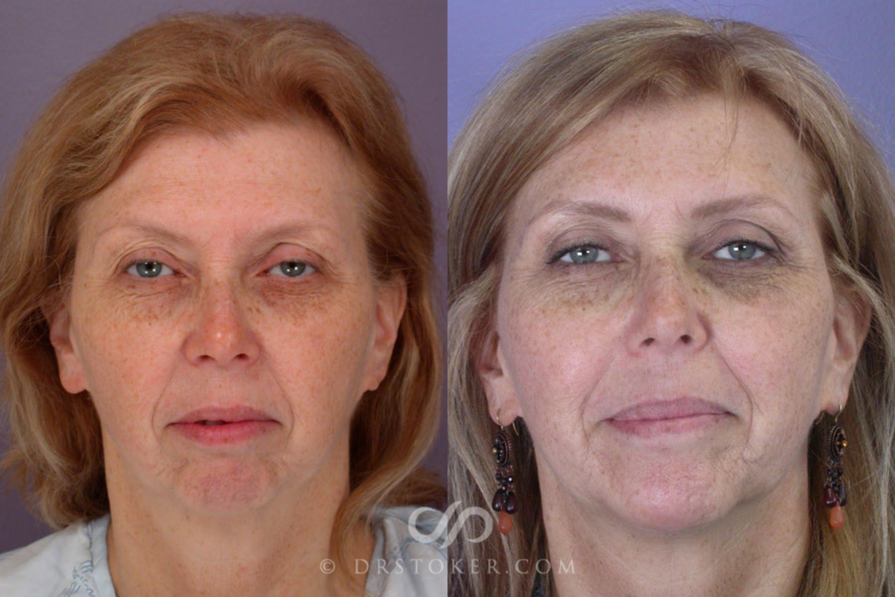 Before & After Eyelid Surgery Case 263 View #1 View in Los Angeles, CA
