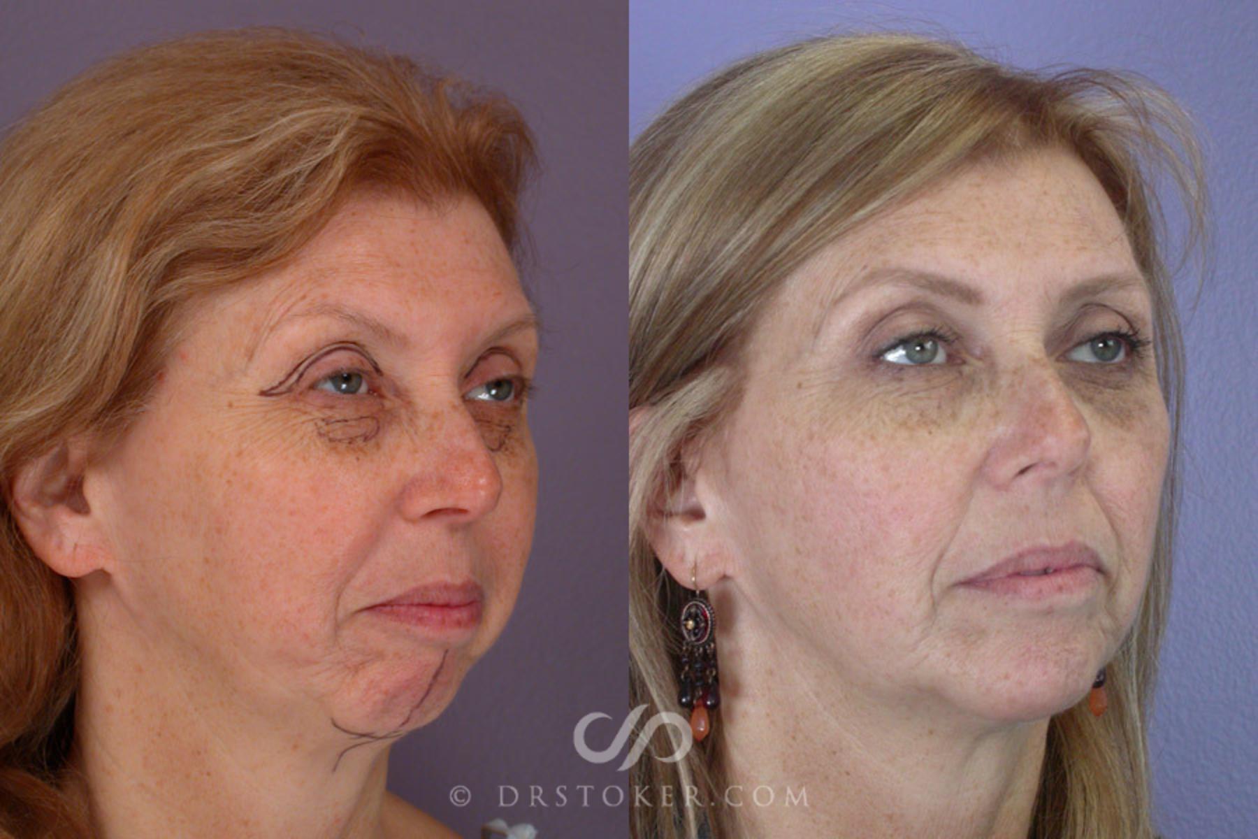 Before & After Cheek/Chin Contouring Case 263 View #2 View in Los Angeles, CA