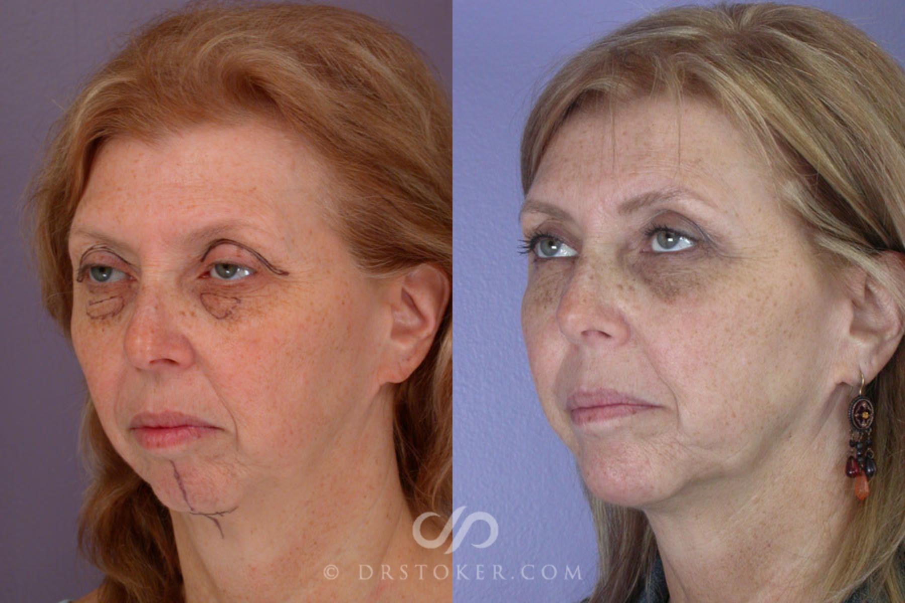 Before & After Eyelid Surgery Case 263 View #3 View in Los Angeles, CA