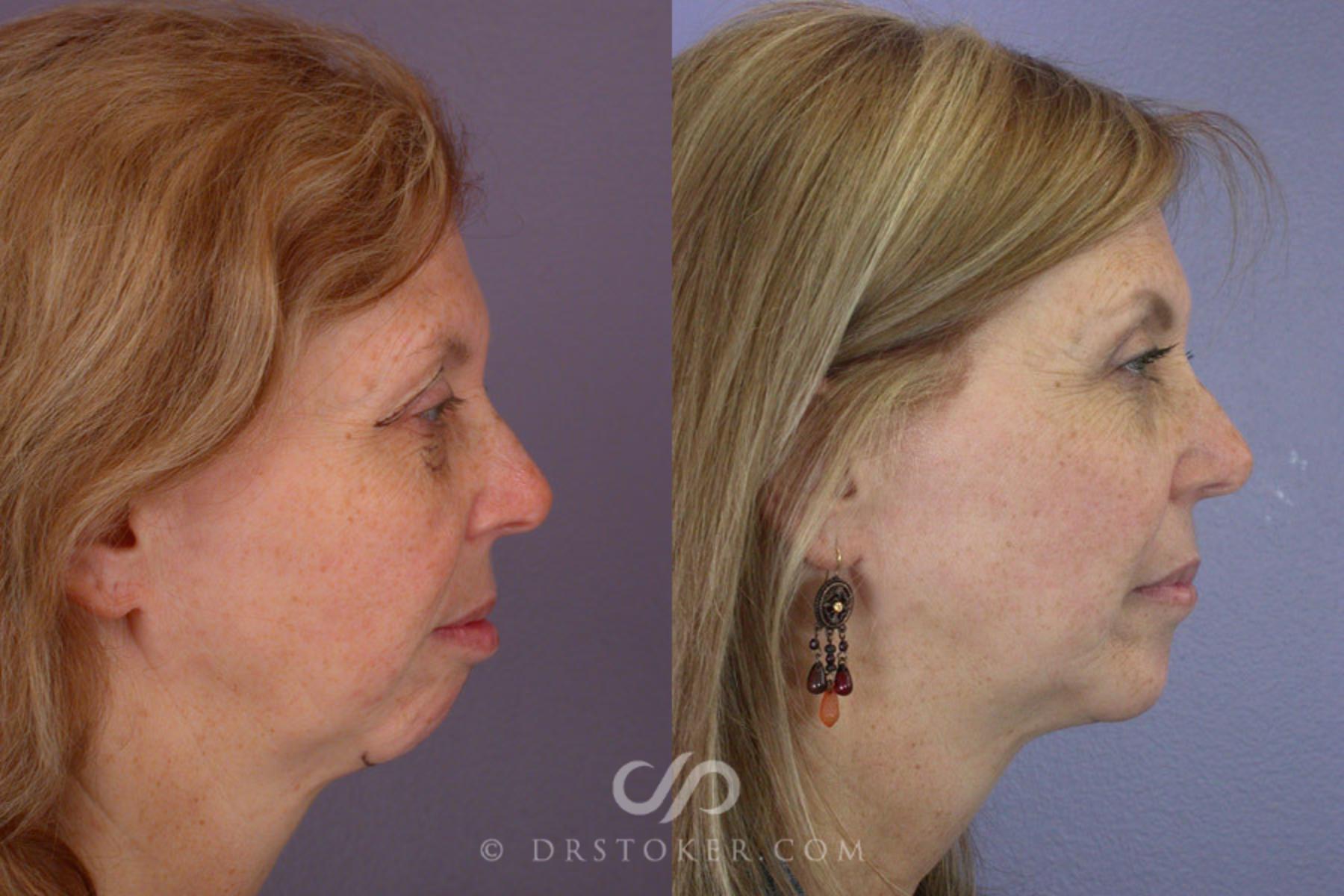 Before & After Eyelid Surgery Case 263 View #4 View in Los Angeles, CA