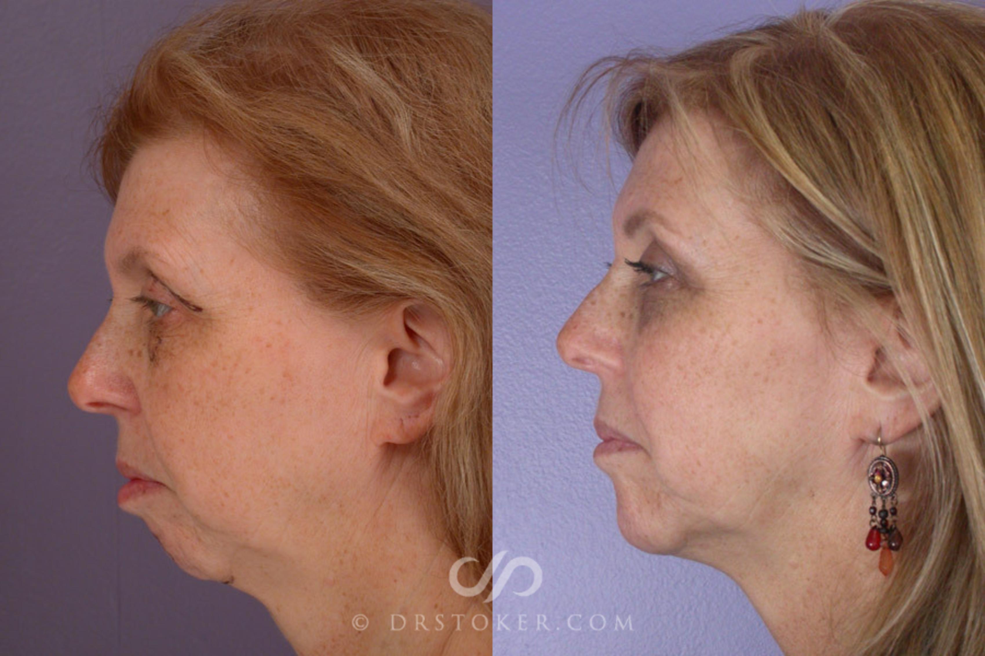 Before & After Cheek/Chin Contouring Case 263 View #5 View in Los Angeles, CA