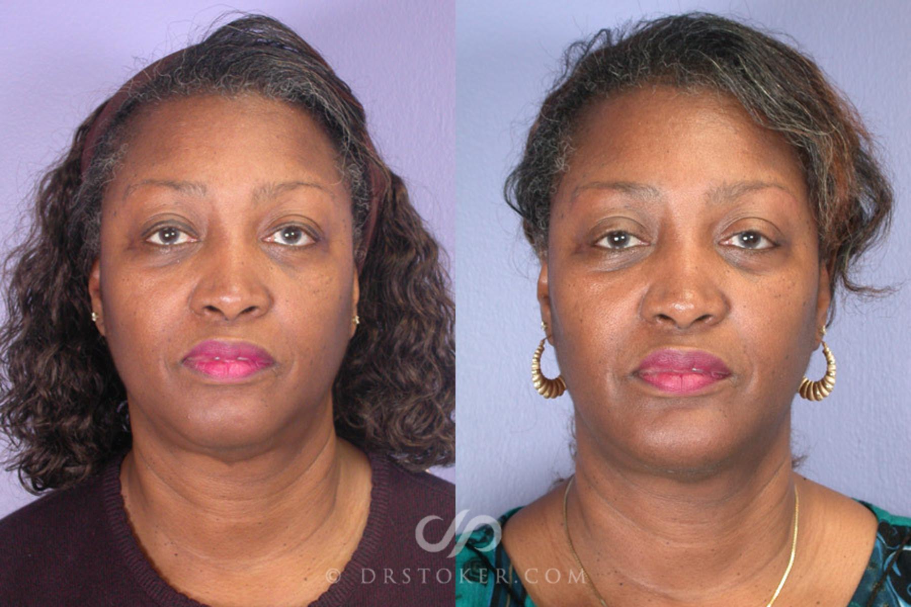 Before & After Cheek/Chin Contouring Case 264 View #1 View in Los Angeles, CA