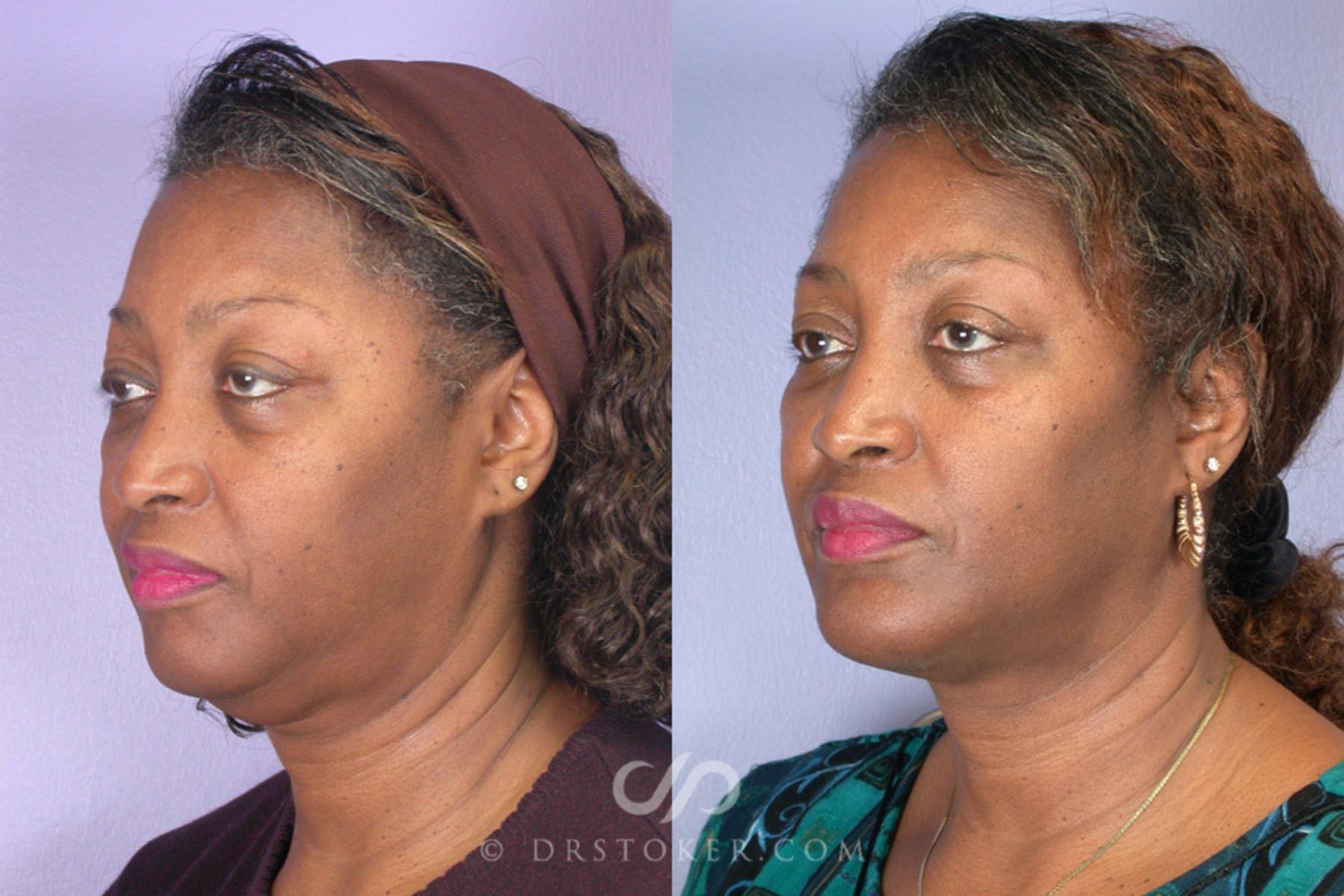 Before & After Cheek/Chin Contouring Case 264 View #2 View in Los Angeles, CA