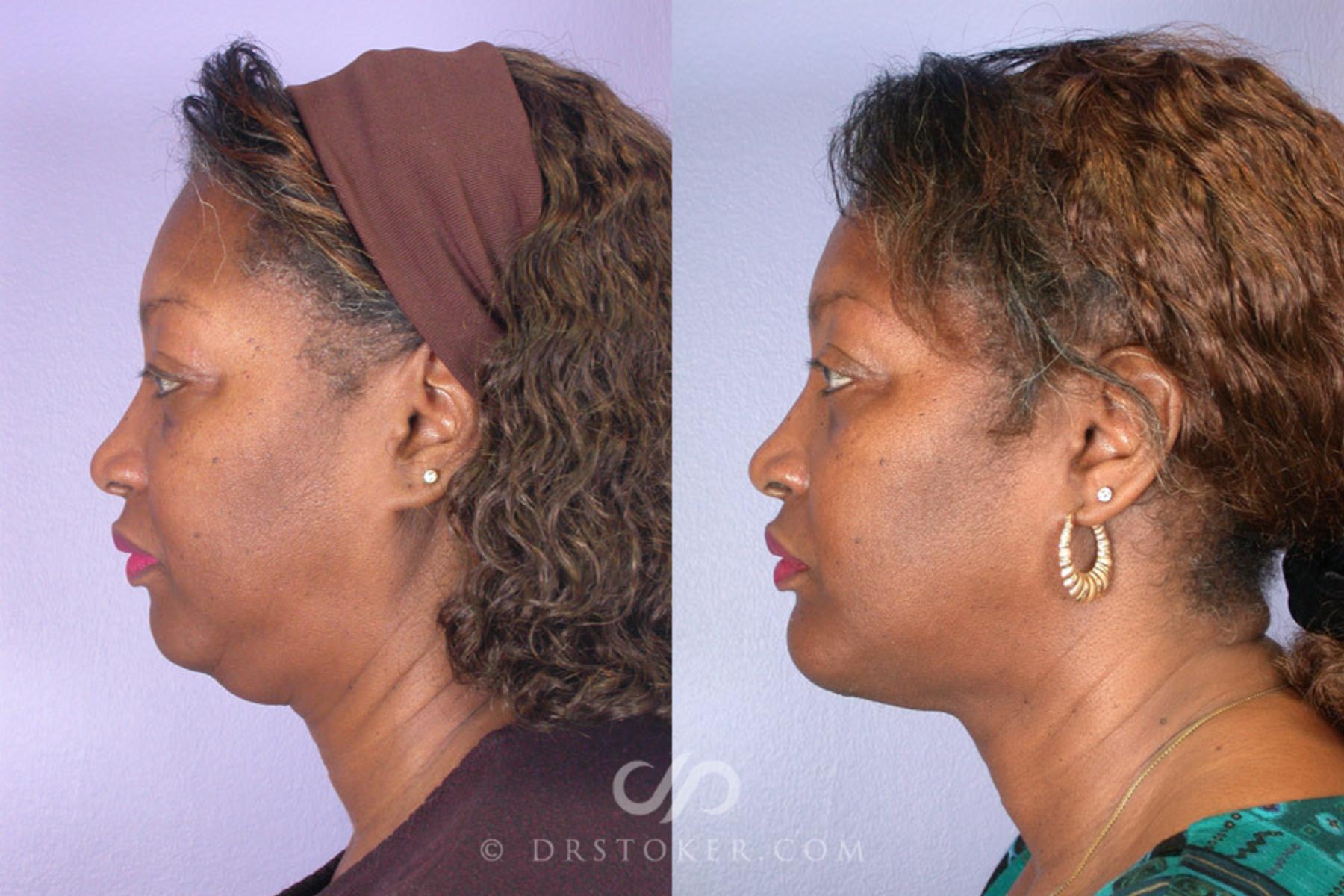 Before & After Cheek/Chin Contouring Case 264 View #3 View in Los Angeles, CA