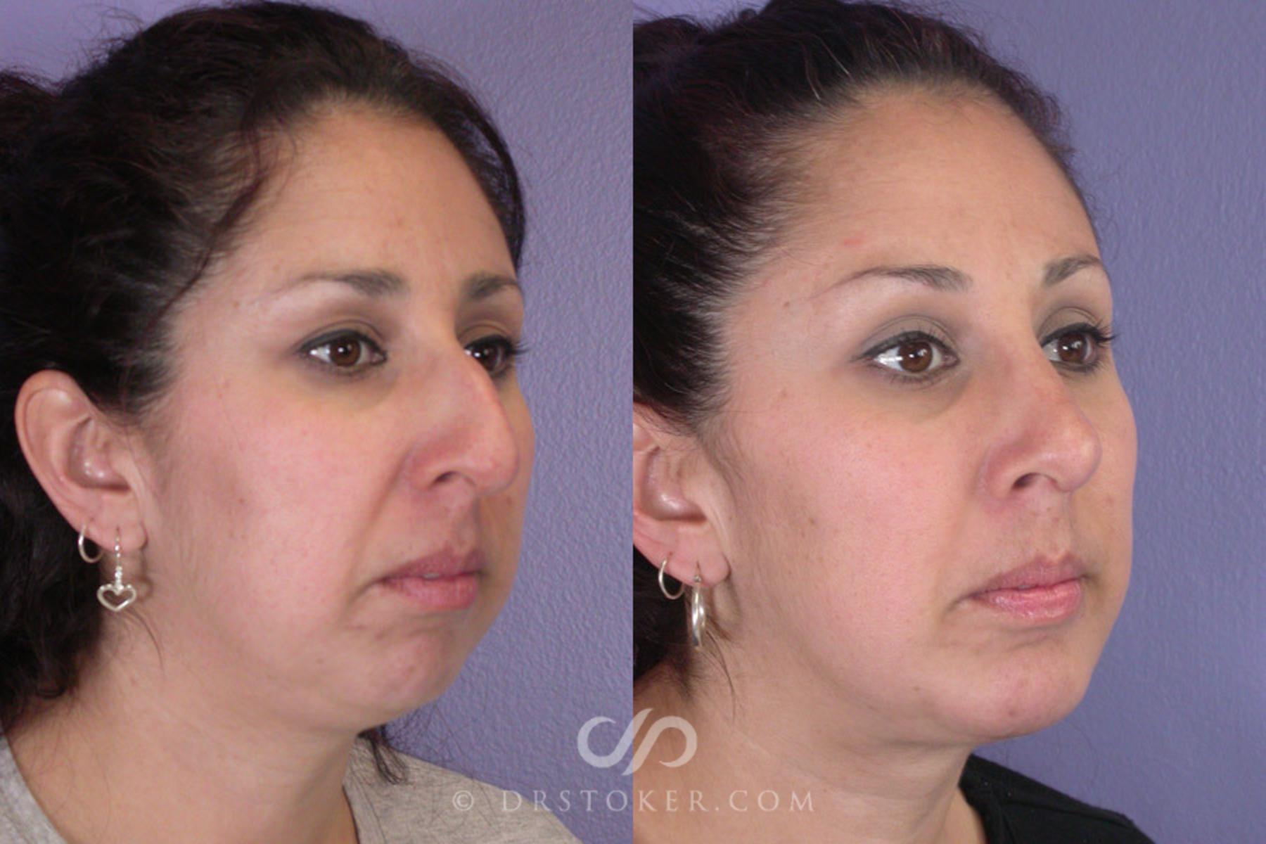 Before & After Rhinoplasty Case 270 View #2 View in Los Angeles, CA