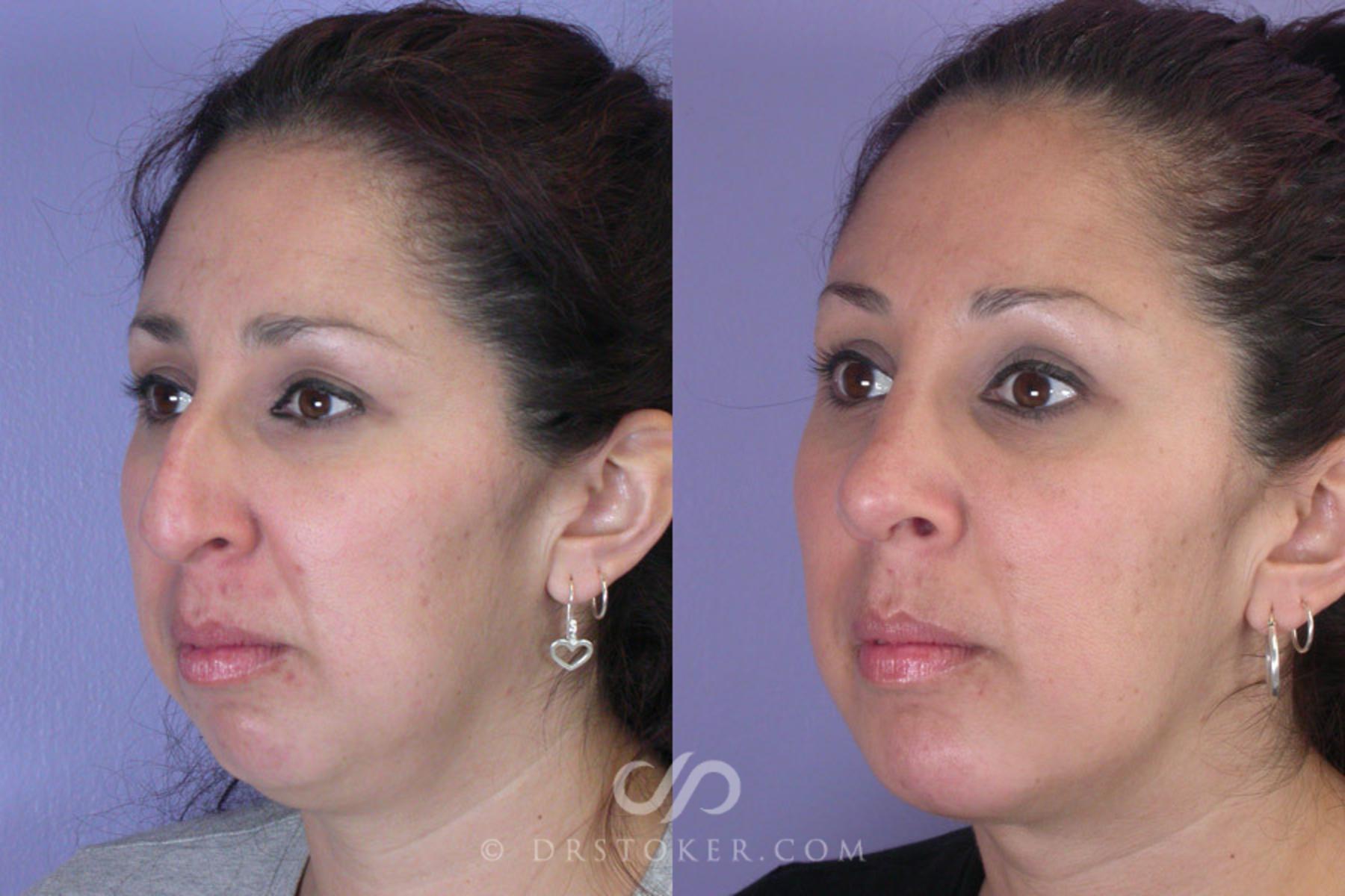 Before & After Cheek/Chin Contouring Case 270 View #3 View in Los Angeles, CA