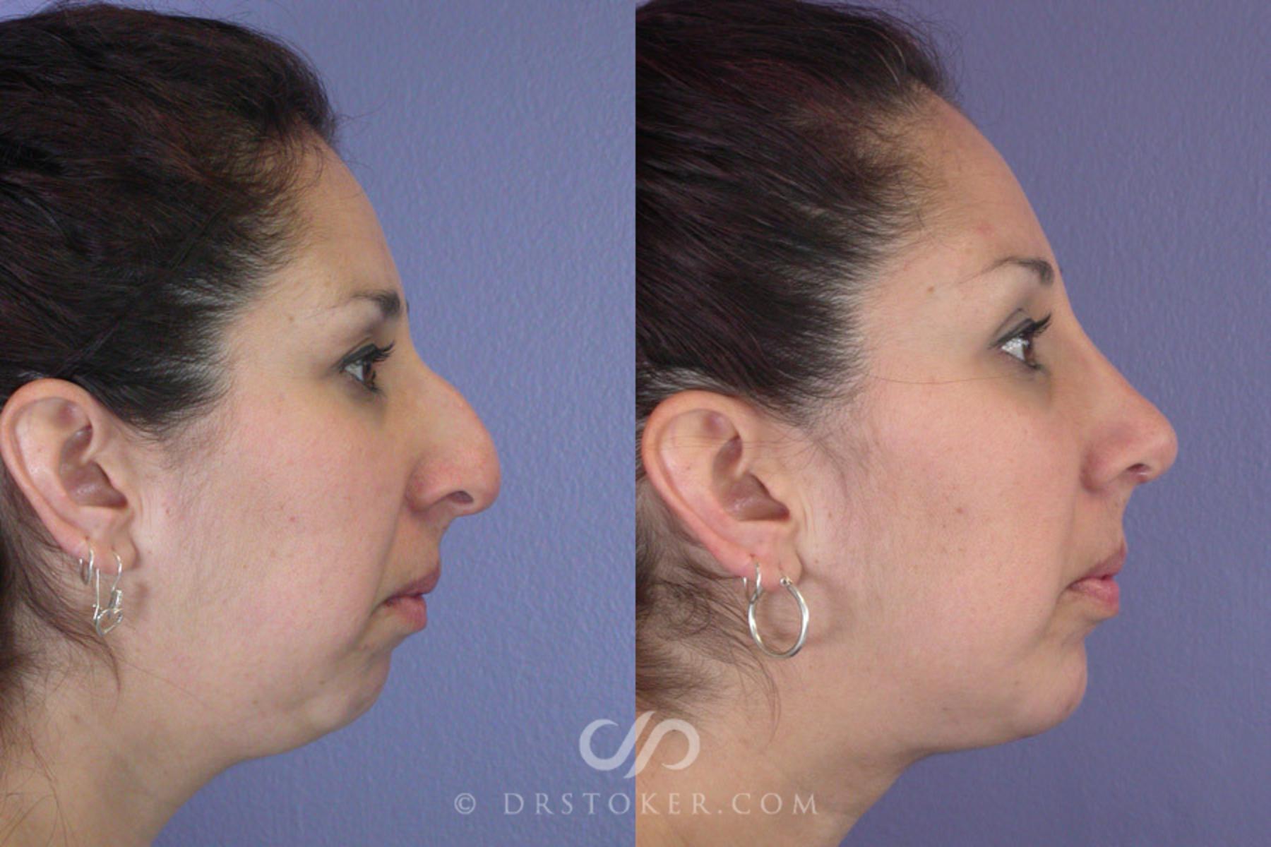 Before & After Cheek/Chin Contouring Case 270 View #4 View in Los Angeles, CA