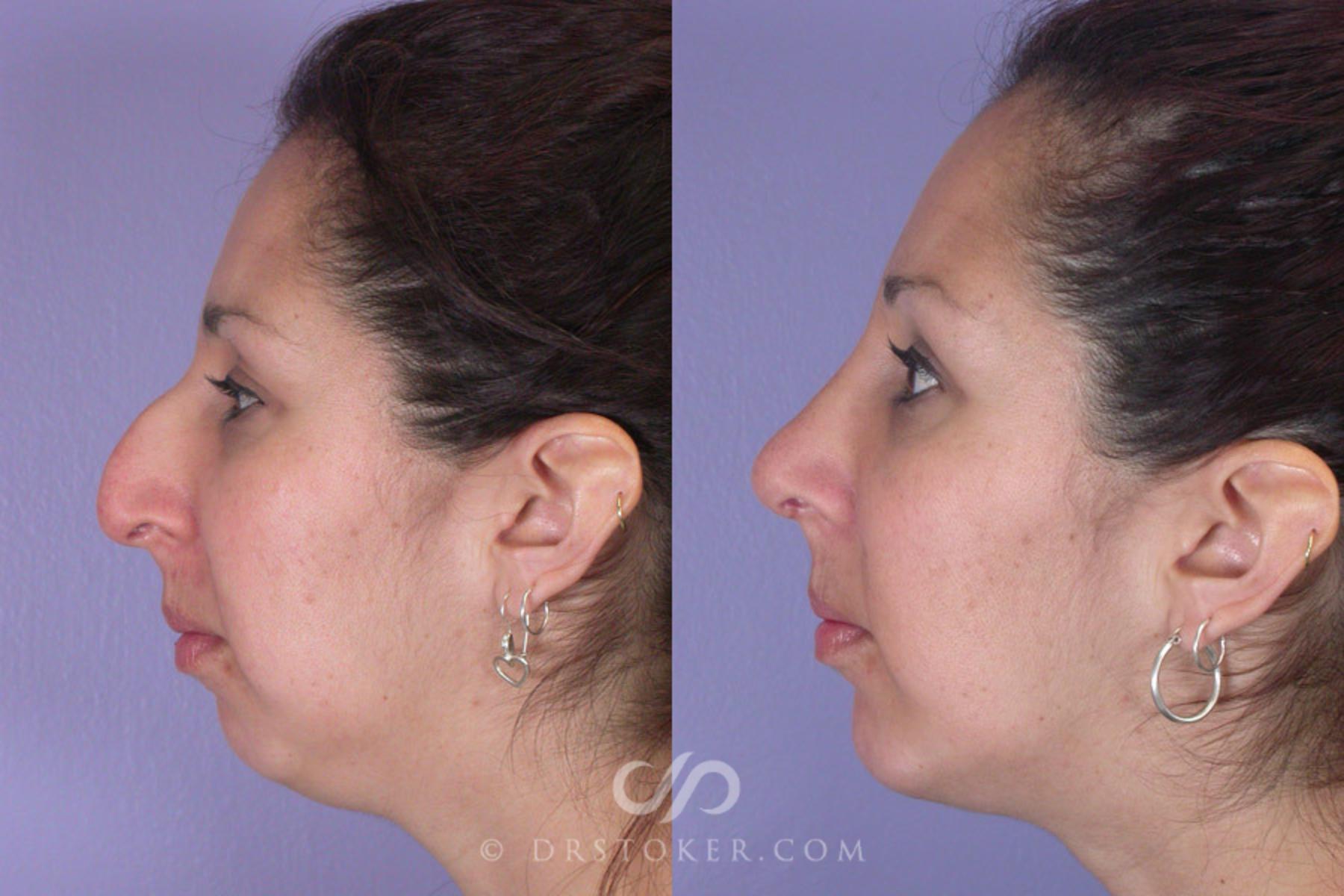 Before & After Cheek/Chin Contouring Case 270 View #5 View in Los Angeles, CA