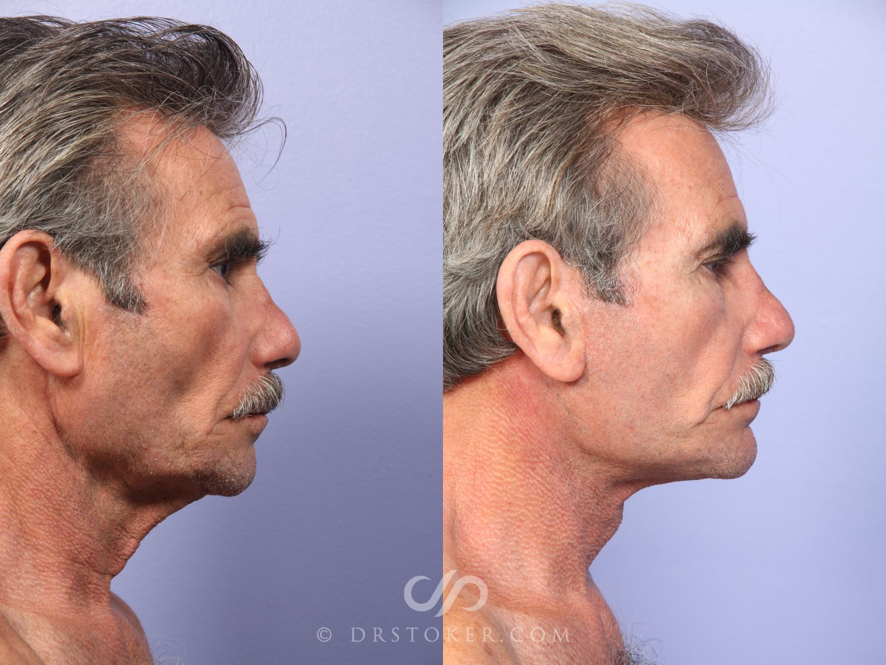 Before & After Cheek/Chin Contouring Case 423 View #3 View in Los Angeles, CA