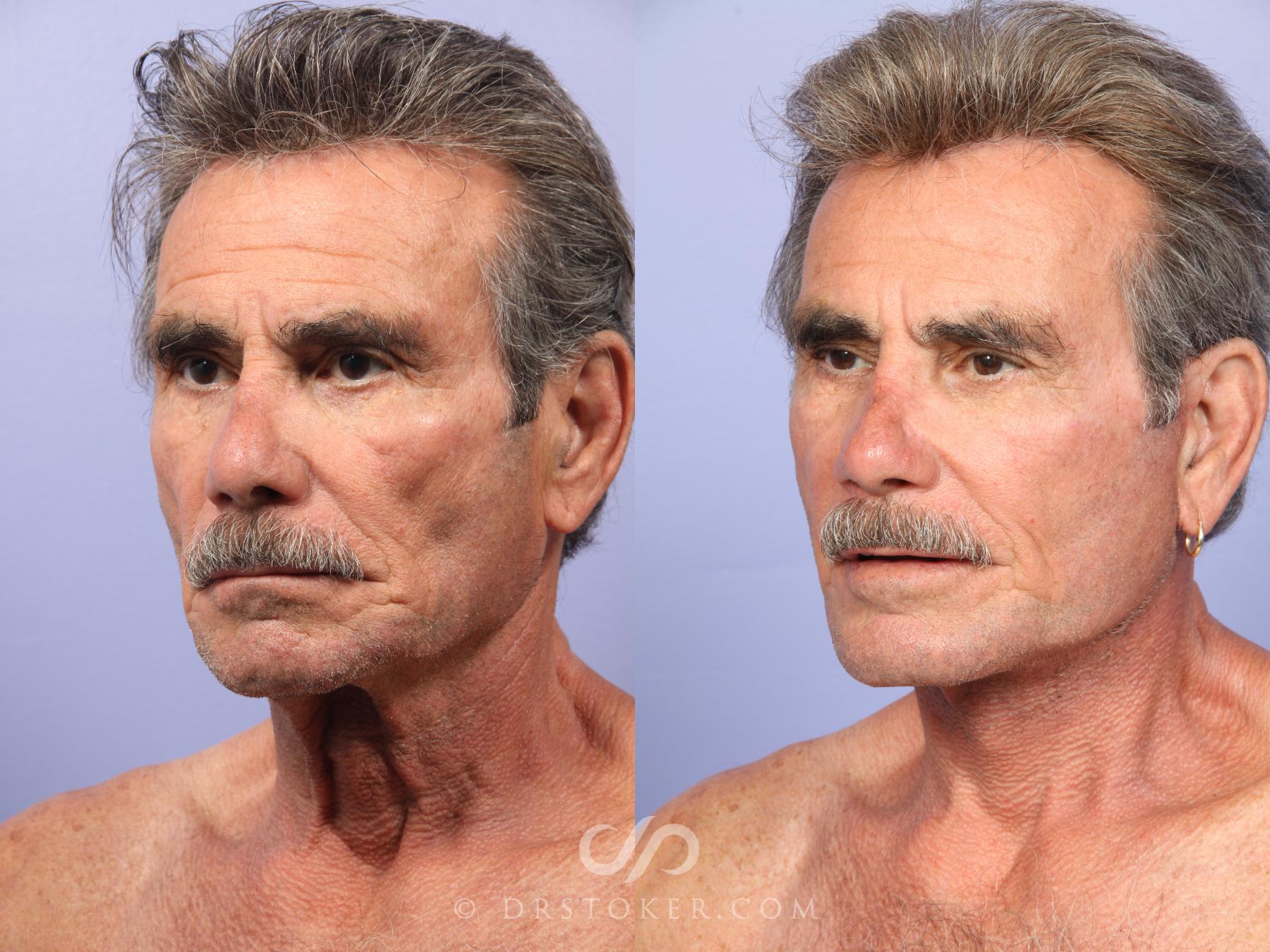 Before & After Cheek/Chin Contouring Case 423 View #4 View in Los Angeles, CA