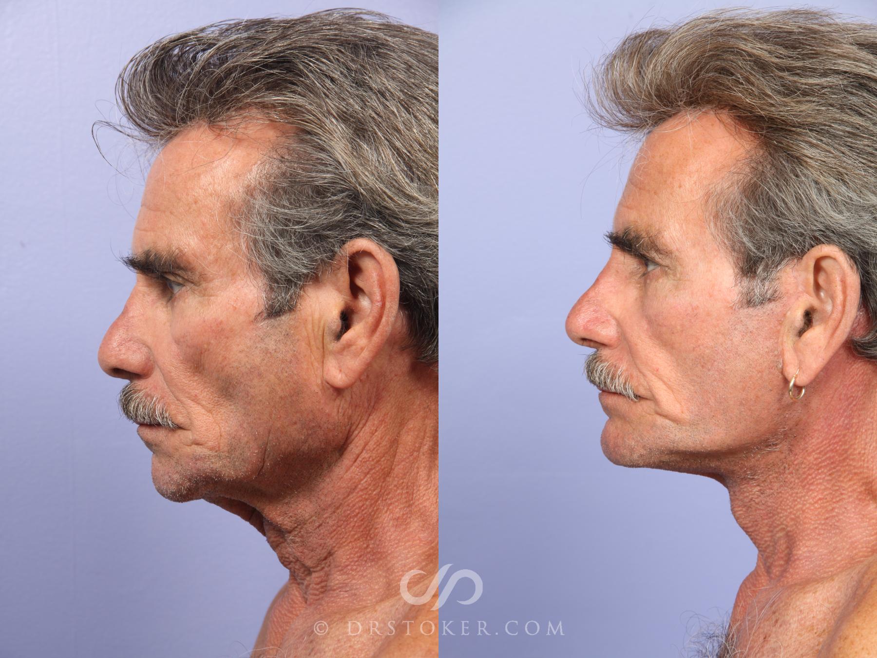 Before & After Facelift - Traceless Facelift Case 423 View #5 View in Los Angeles, CA