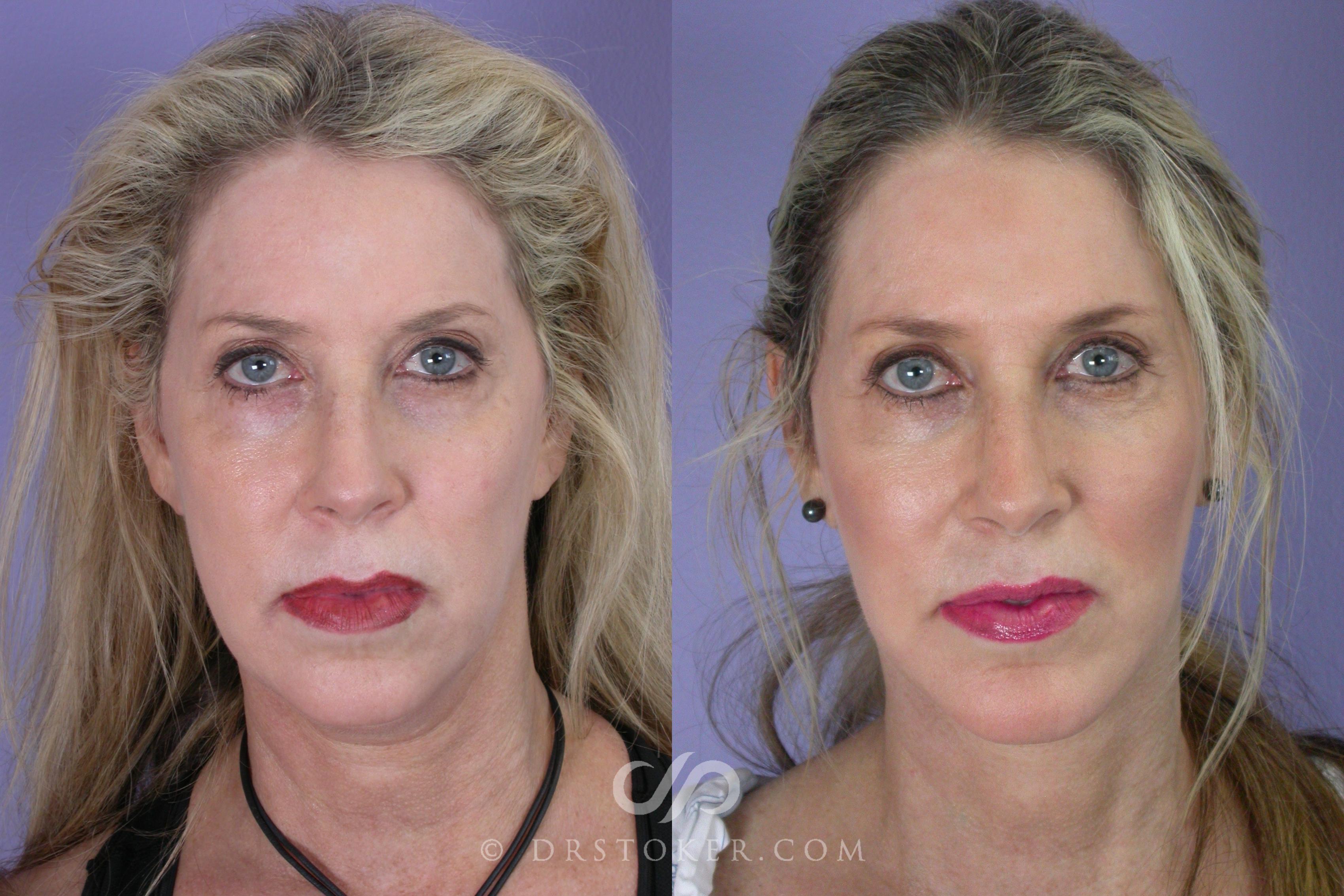 Before & After Cheek/Chin Contouring Case 458 View #1 View in Los Angeles, CA