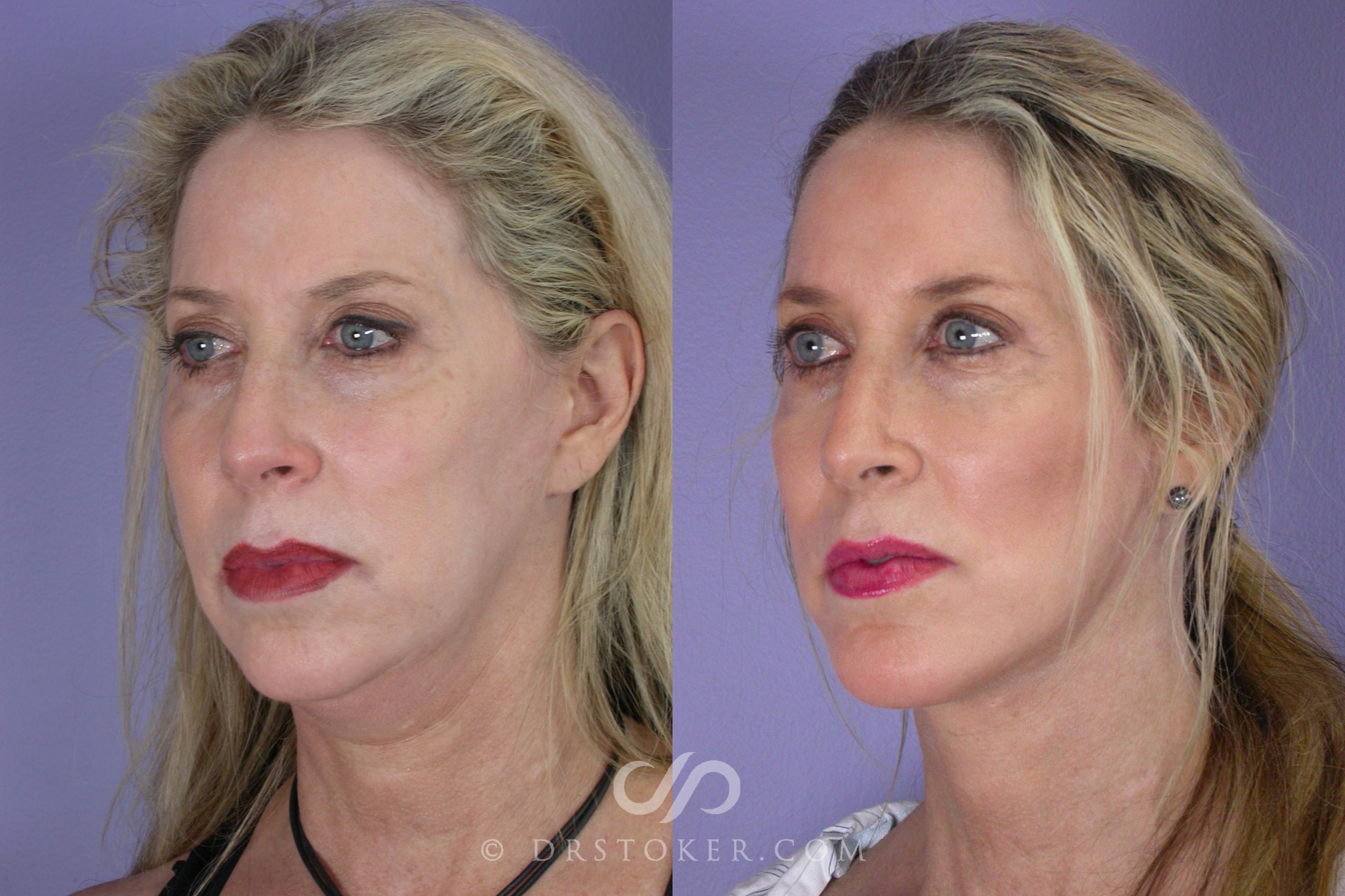 Before & After Cheek/Chin Contouring Case 458 View #2 View in Los Angeles, CA