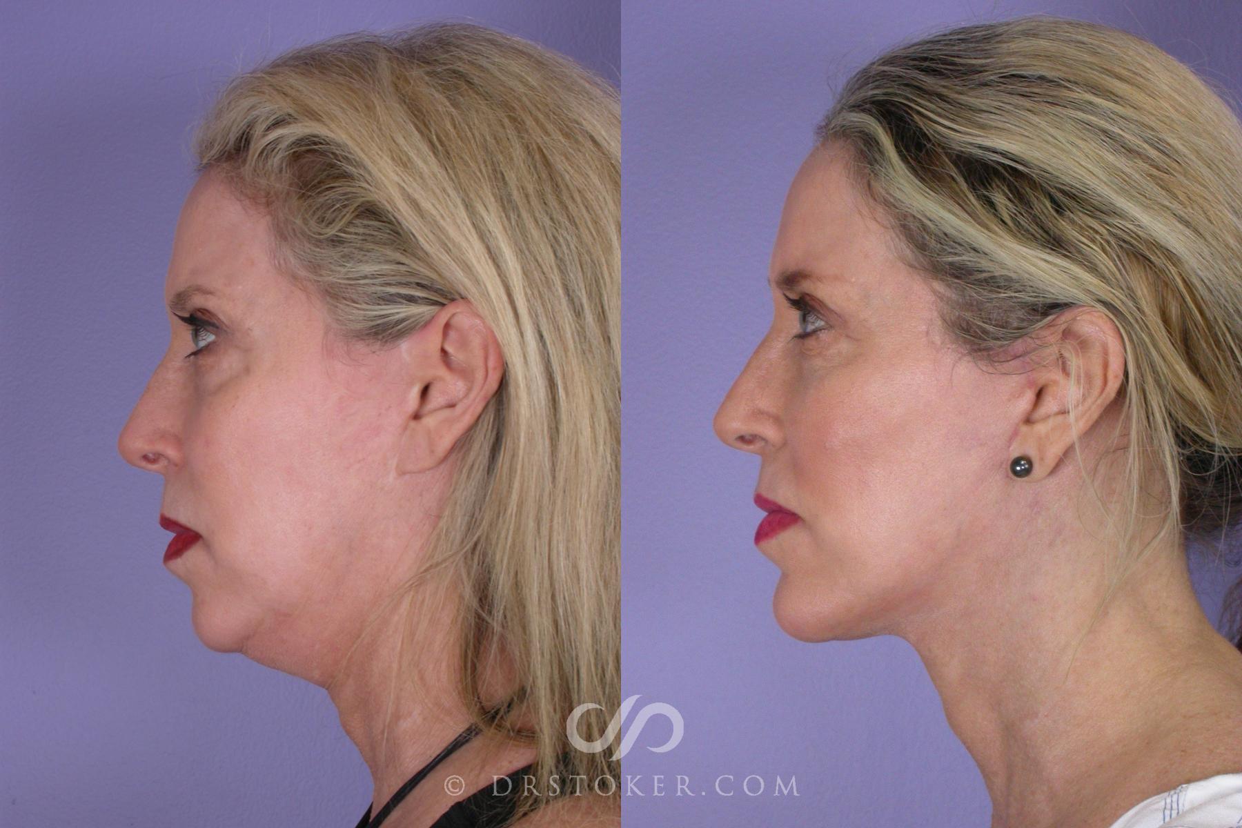Before & After Neck Lift - Traceless Neck Lift  Case 458 View #3 View in Los Angeles, CA