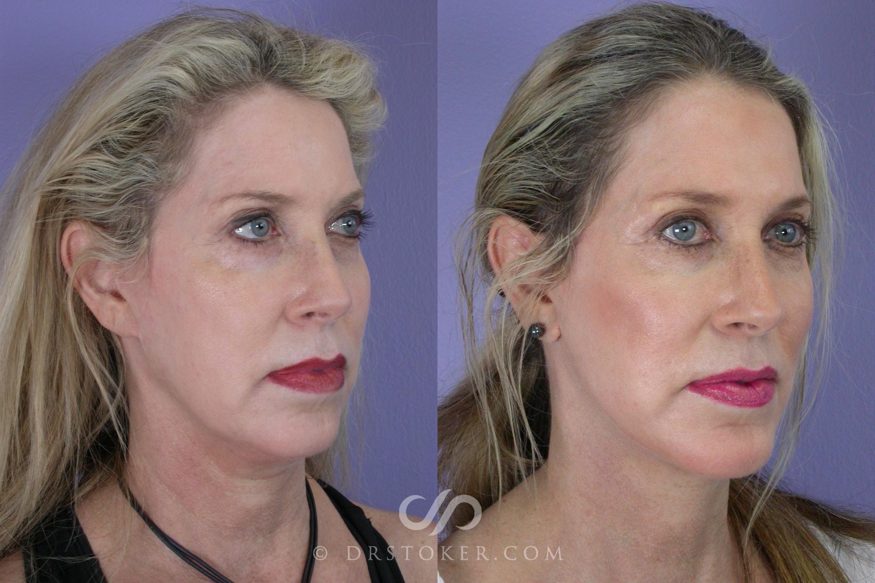Before & After Cheek/Chin Contouring Case 458 View #4 View in Los Angeles, CA