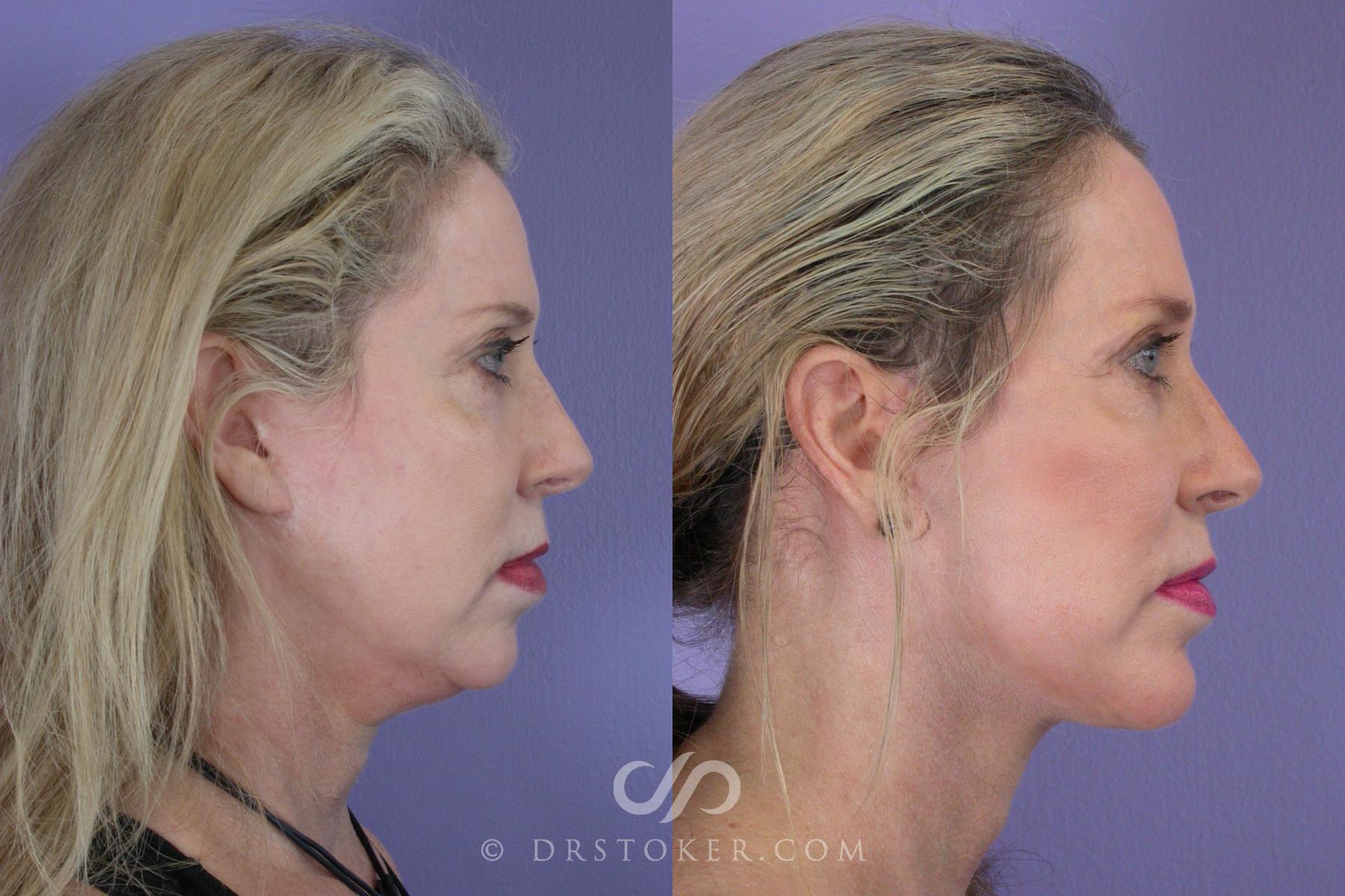 Before & After Cheek/Chin Contouring Case 458 View #5 View in Los Angeles, CA