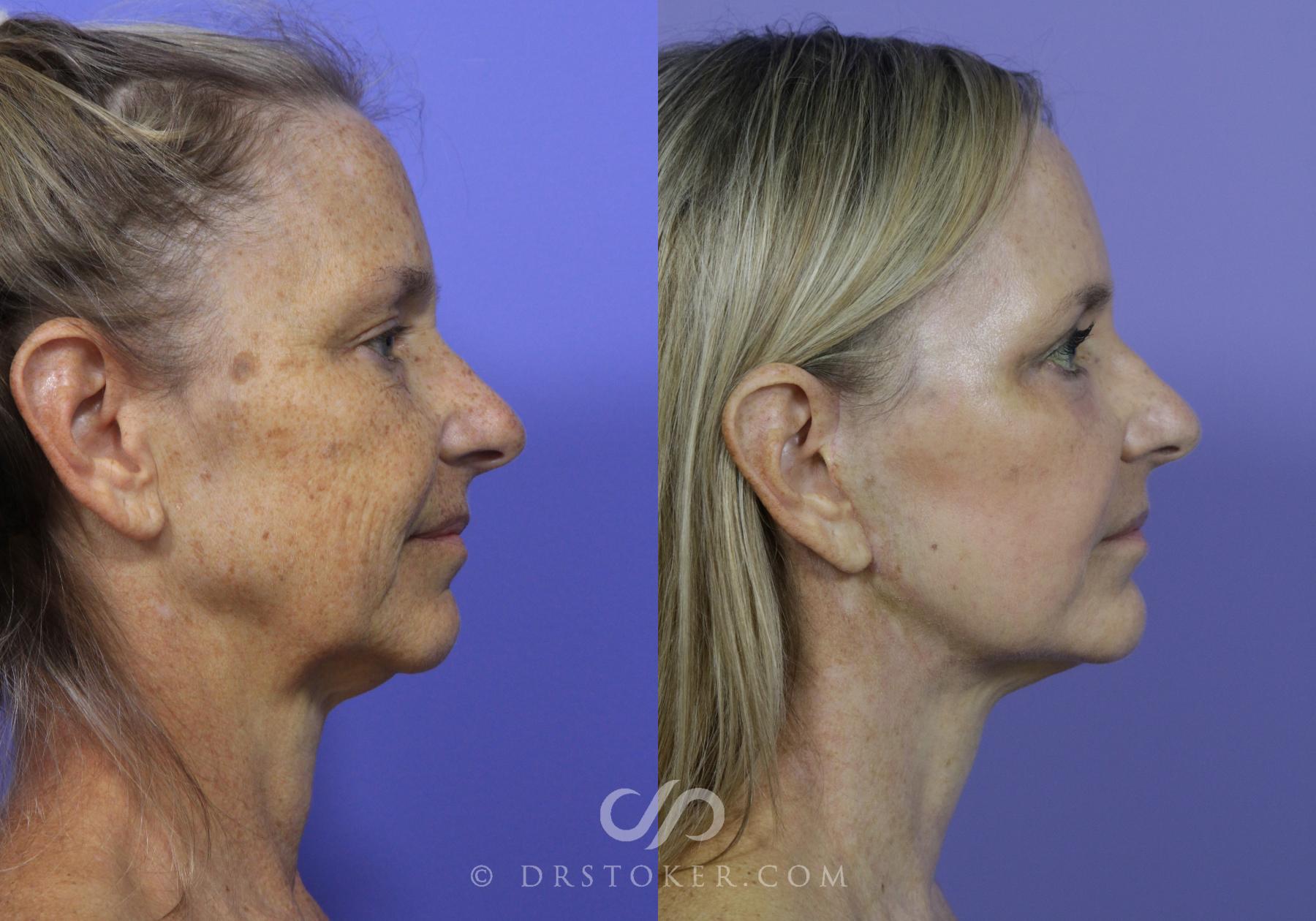 Before & After Cheek/Chin Contouring Case 887 View #2 View in Los Angeles, CA