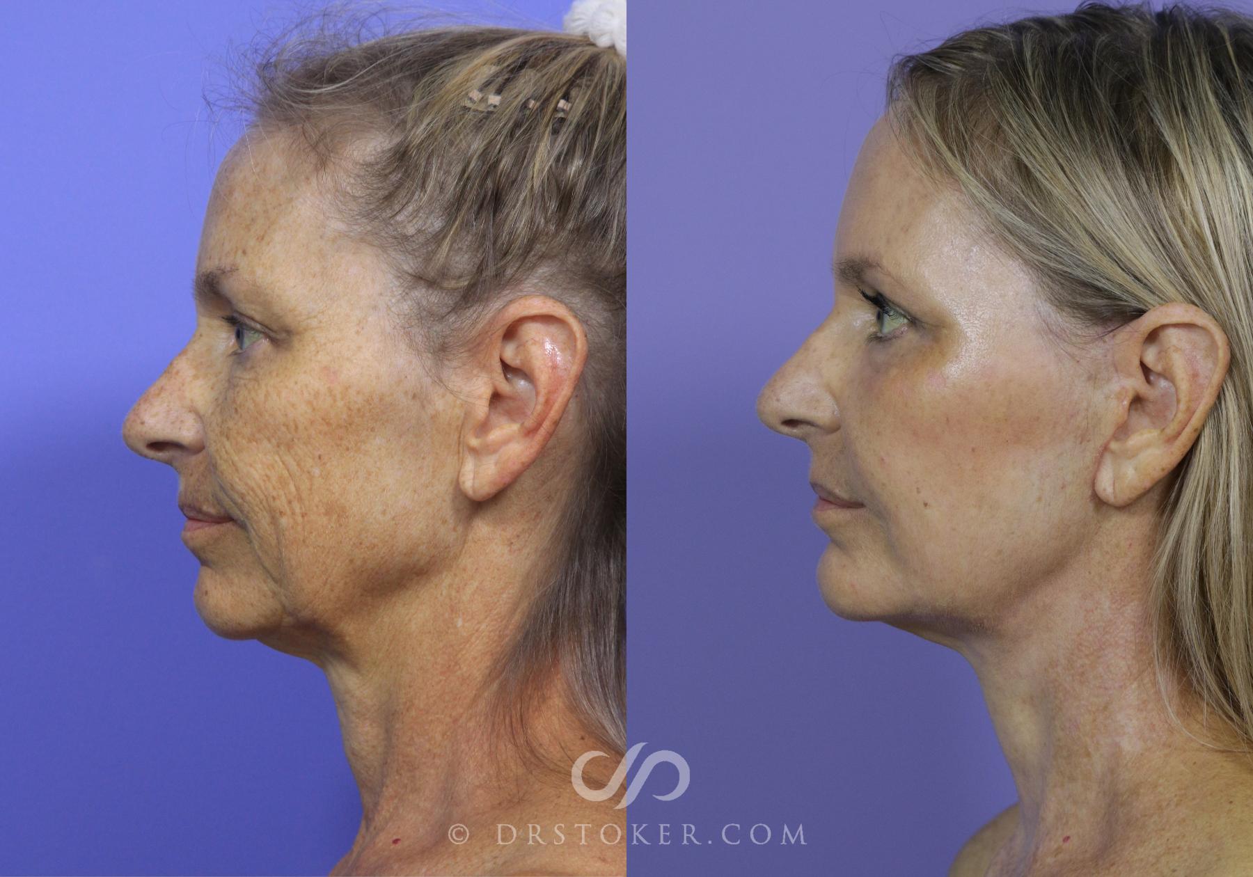 Before & After Cheek/Chin Contouring Case 887 View #4 View in Los Angeles, CA