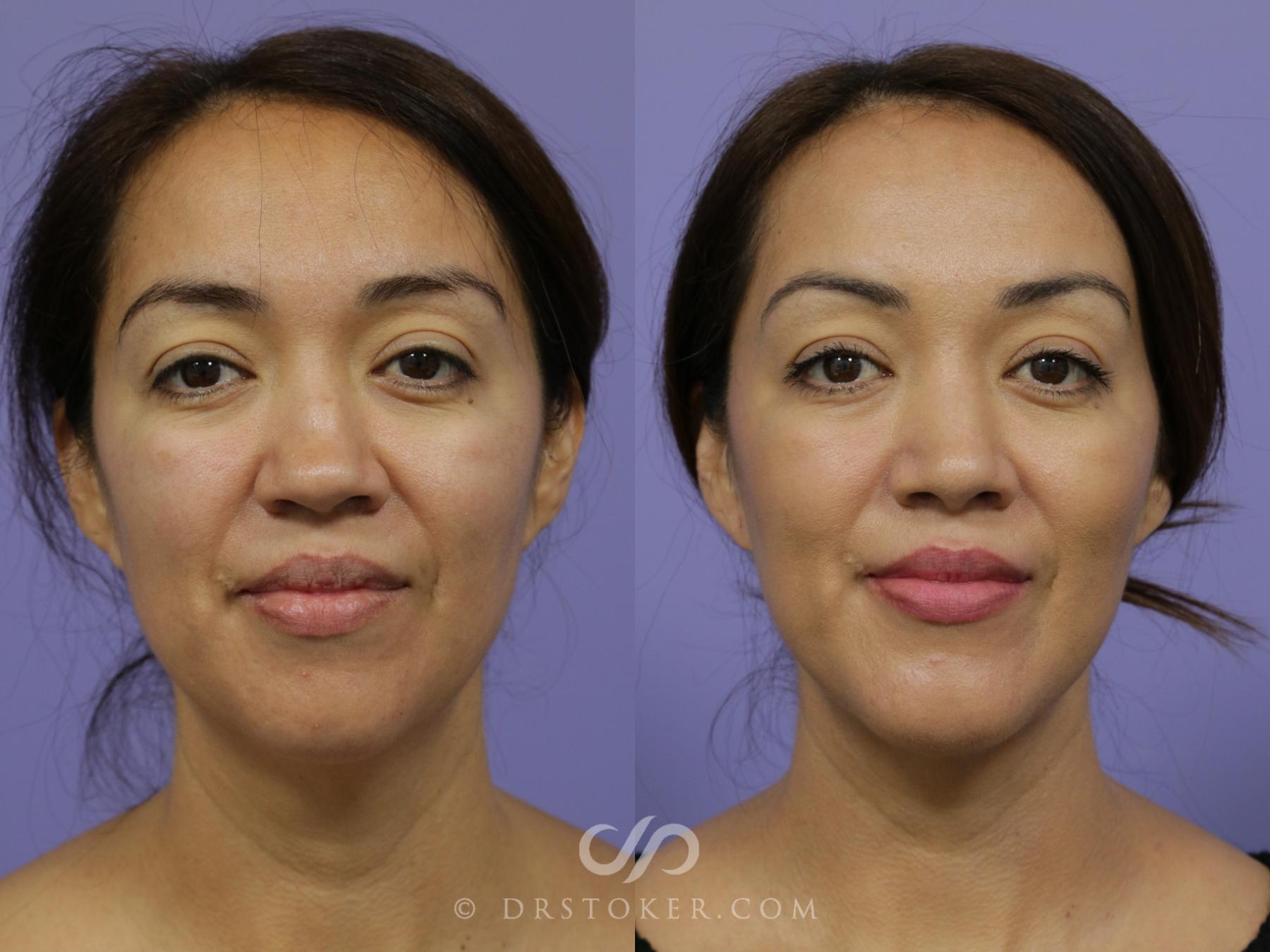 Before & After Cheek/Chin Contouring Case 888 View #1 View in Los Angeles, CA