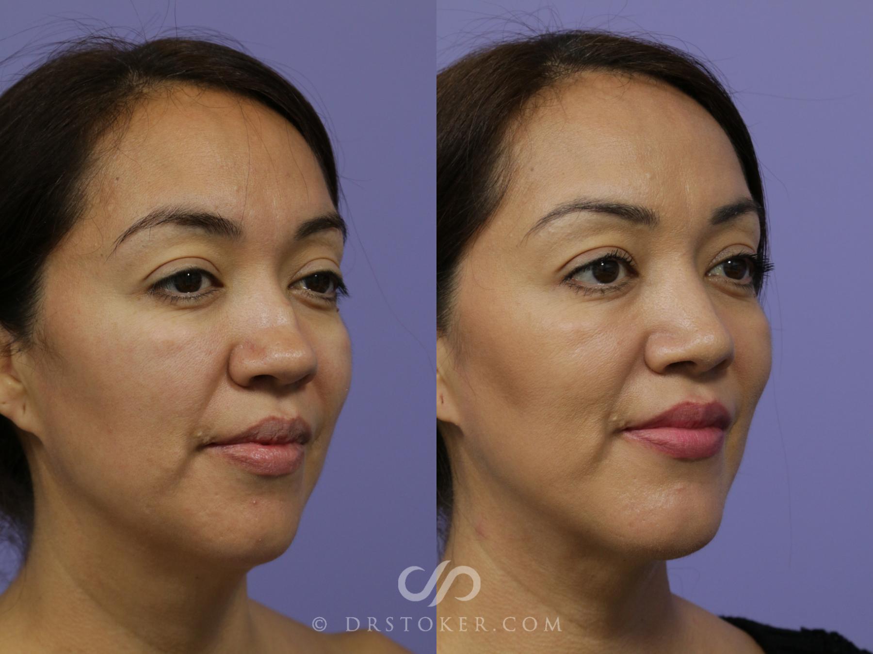 Before & After Cheek/Chin Contouring Case 888 View #2 View in Los Angeles, CA