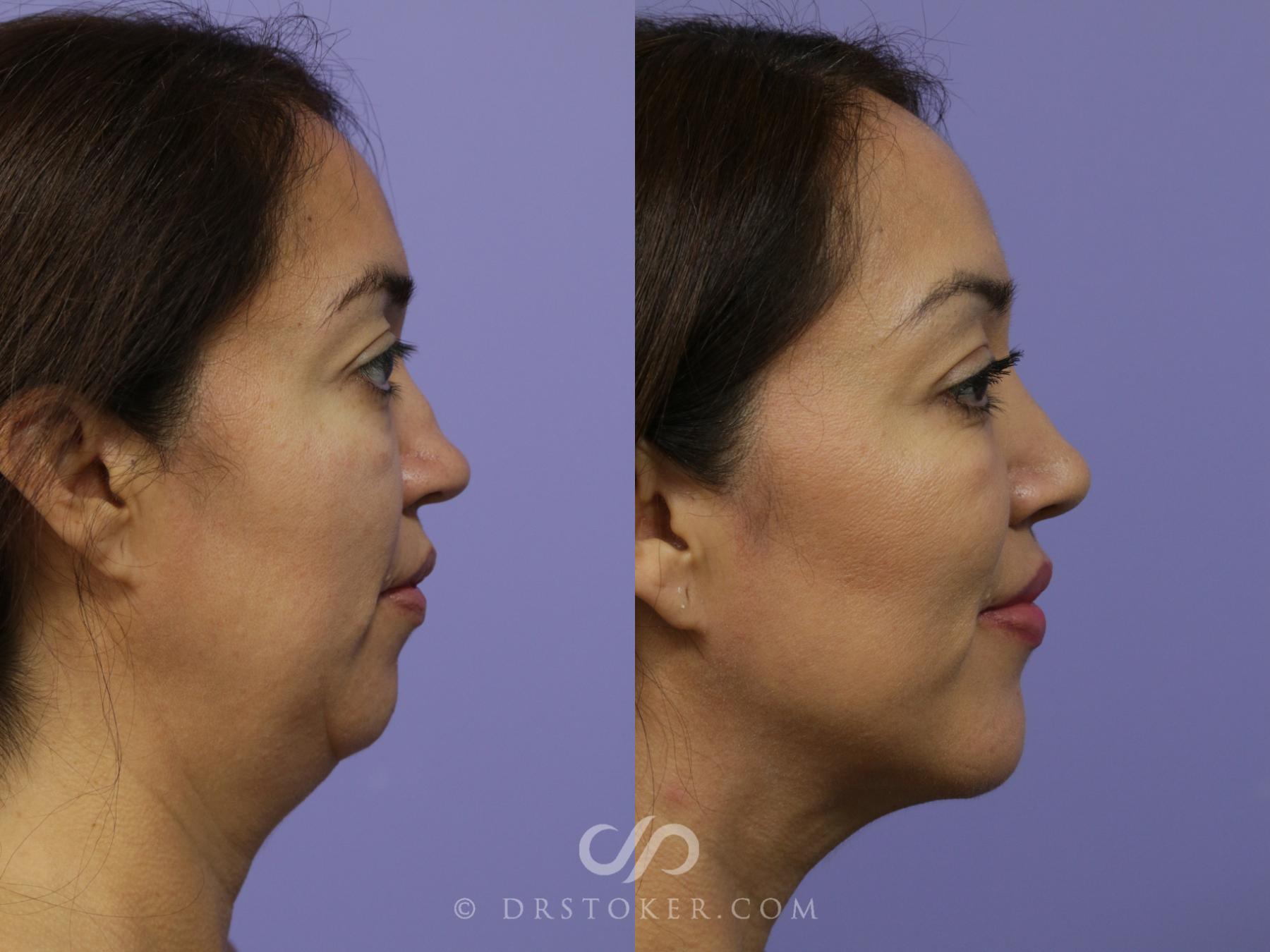 Before & After Cheek/Chin Contouring Case 888 View #3 View in Los Angeles, CA