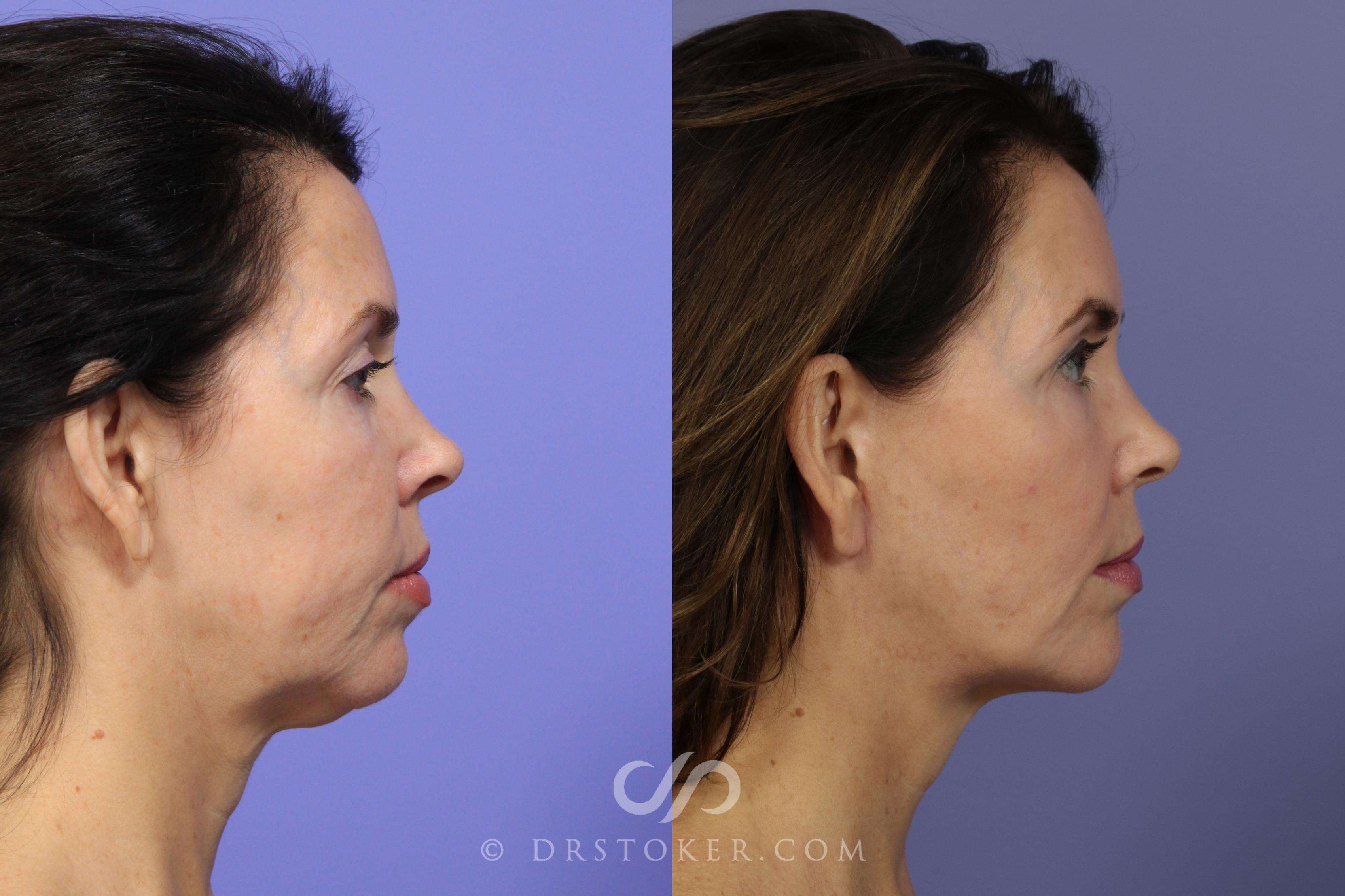 Before & After Chin Augmentation Case 889 View #1 View in Los Angeles, CA