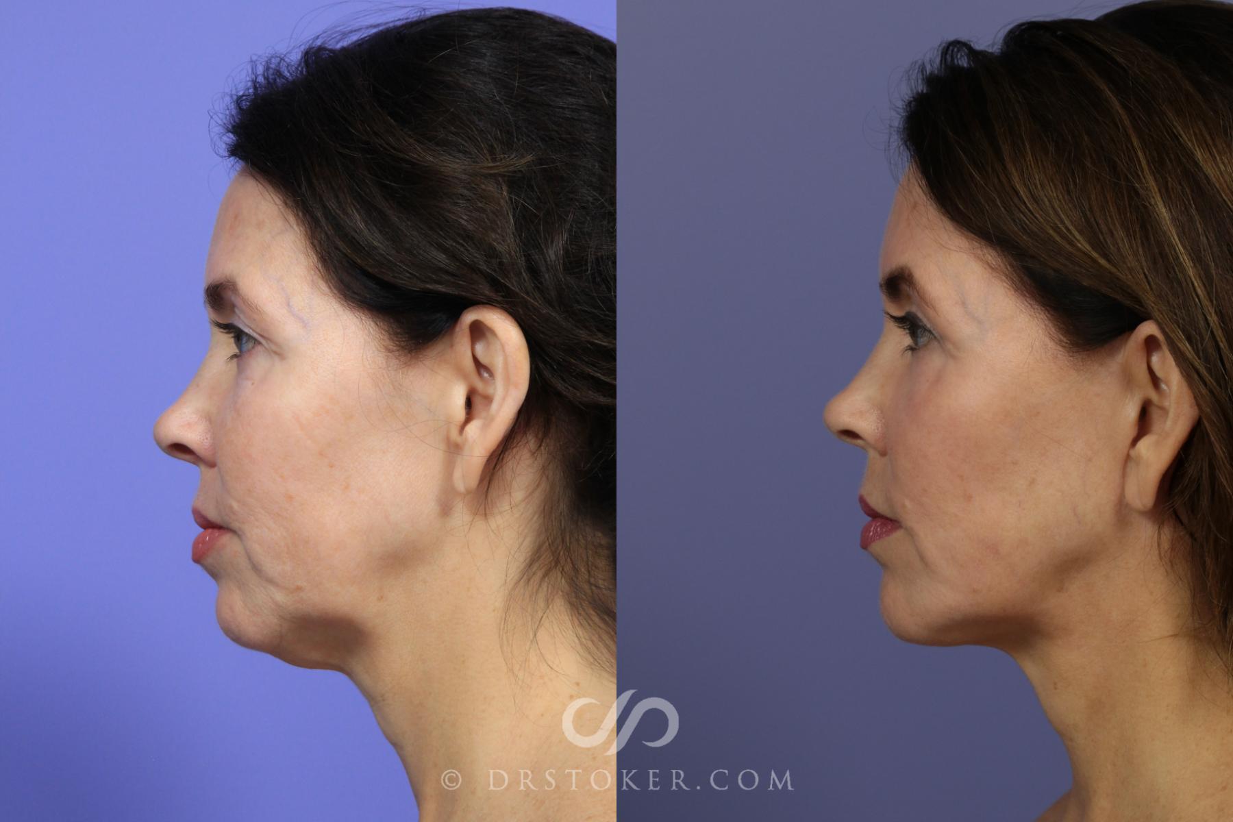 Before & After Cheek/Chin Contouring Case 889 View #2 View in Los Angeles, CA