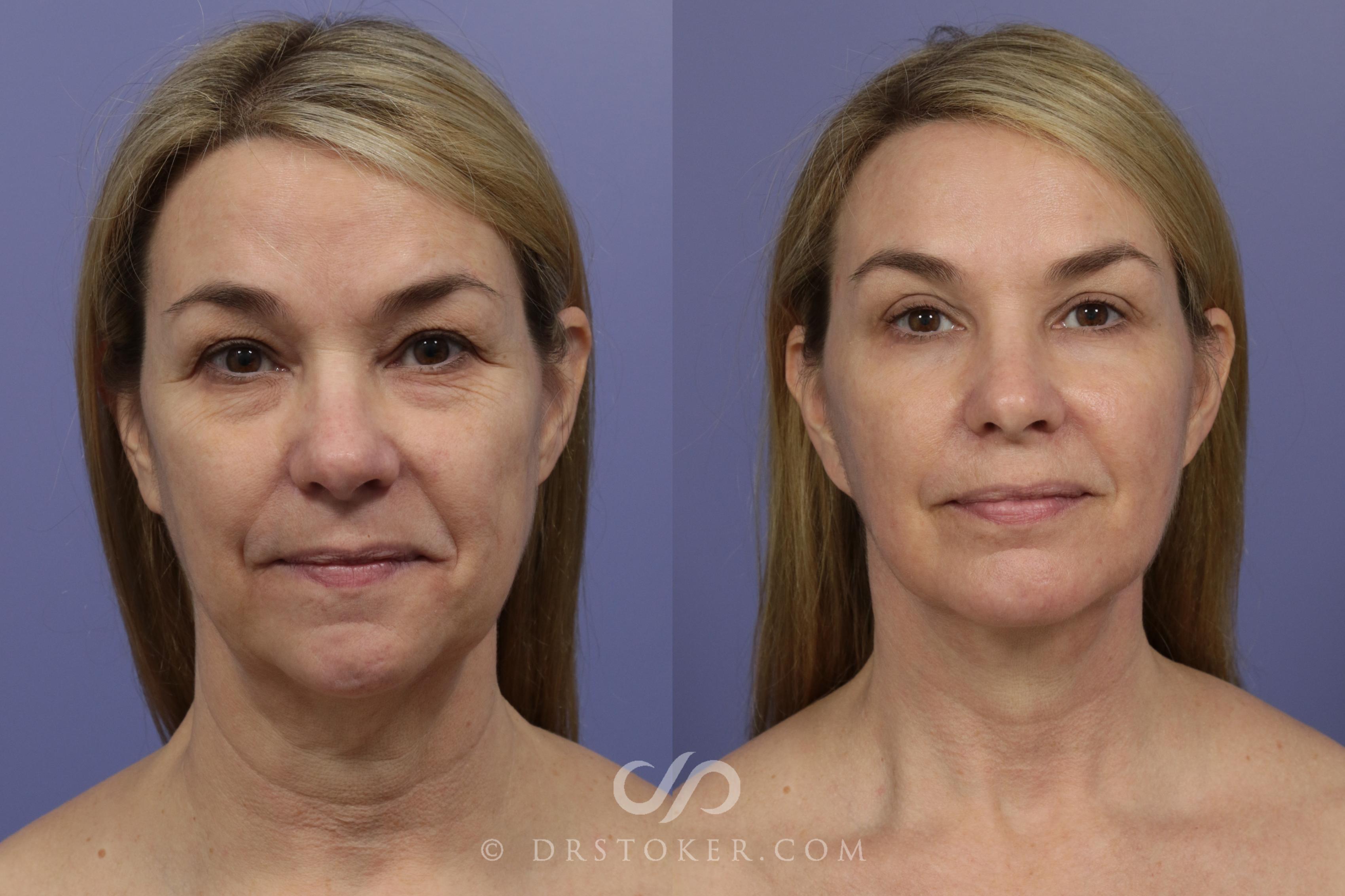 Before & After Cheek/Chin Contouring Case 891 View #1 View in Los Angeles, CA