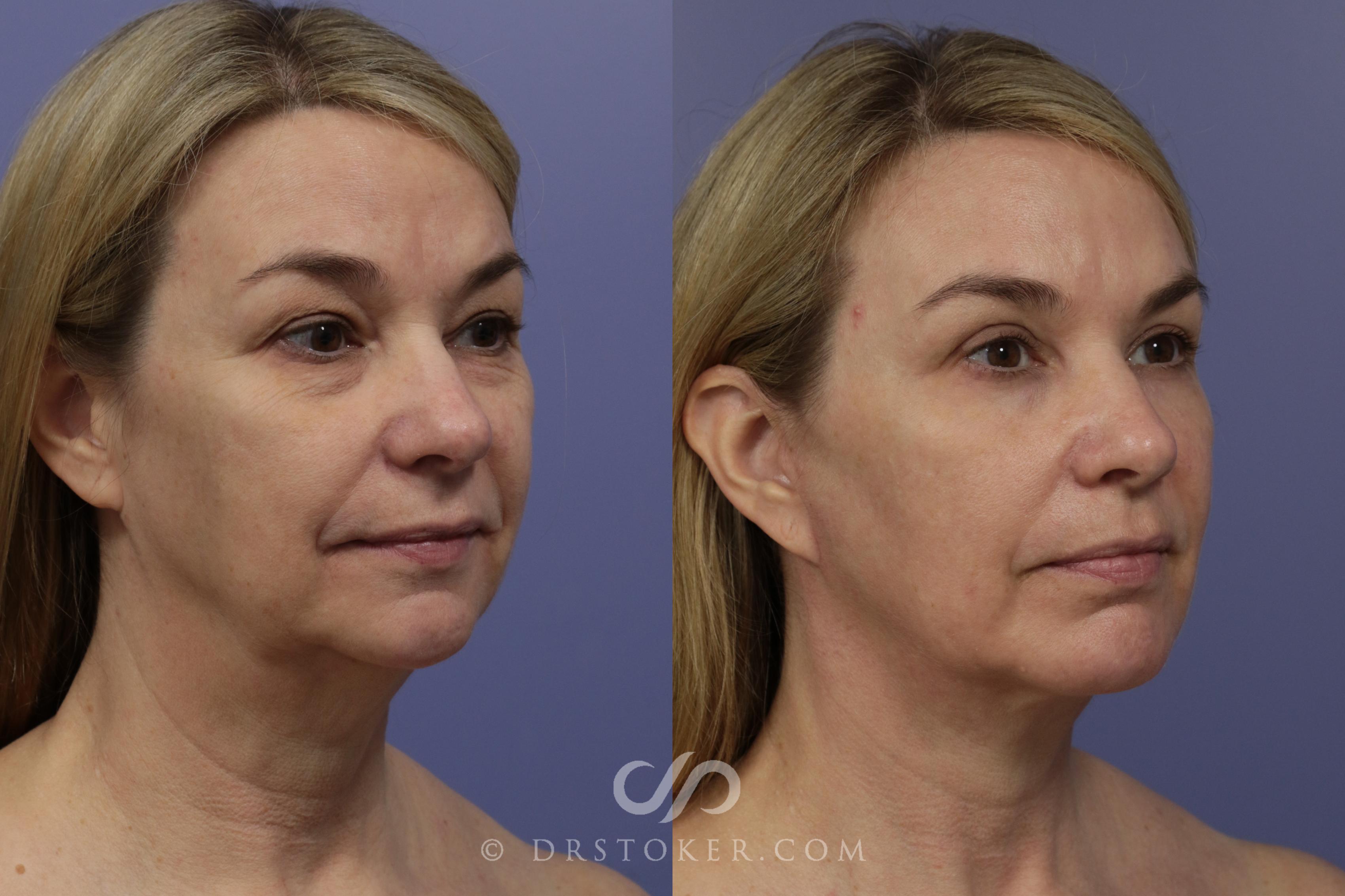 Before & After Cheek/Chin Contouring Case 891 View #2 View in Los Angeles, CA