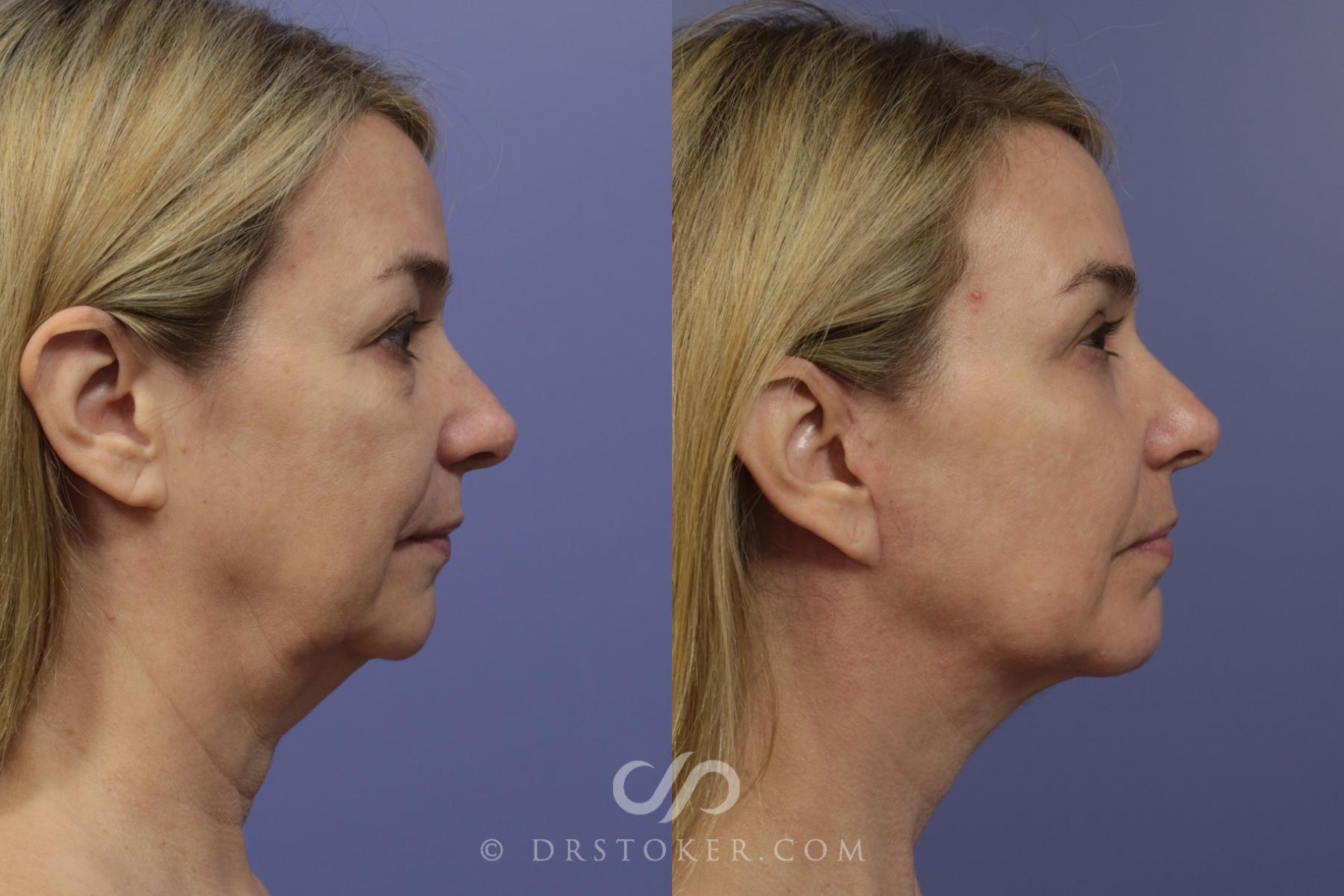 Before & After Cheek/Chin Contouring Case 891 View #3 View in Los Angeles, CA