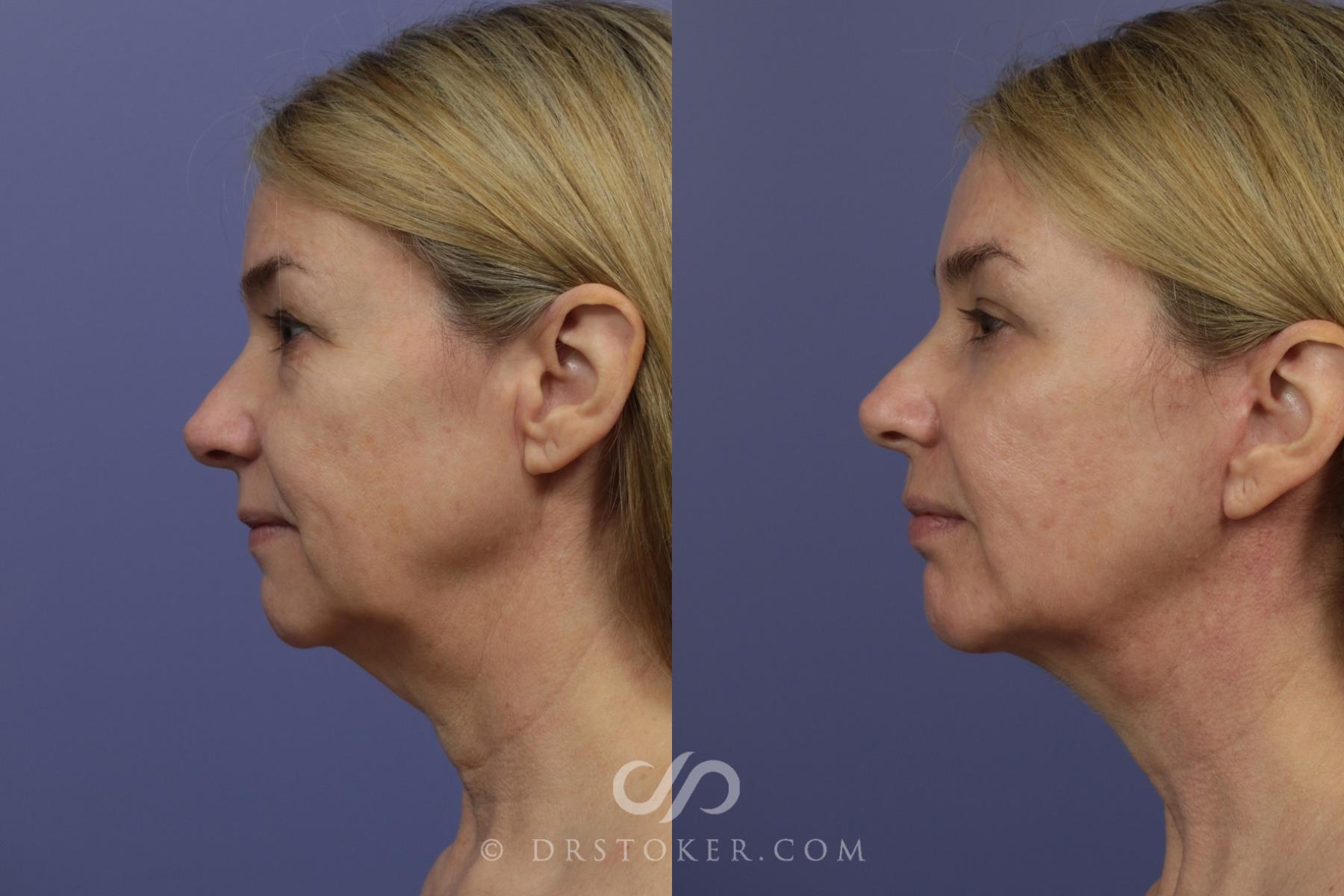 Before & After Cheek/Chin Contouring Case 891 View #4 View in Los Angeles, CA
