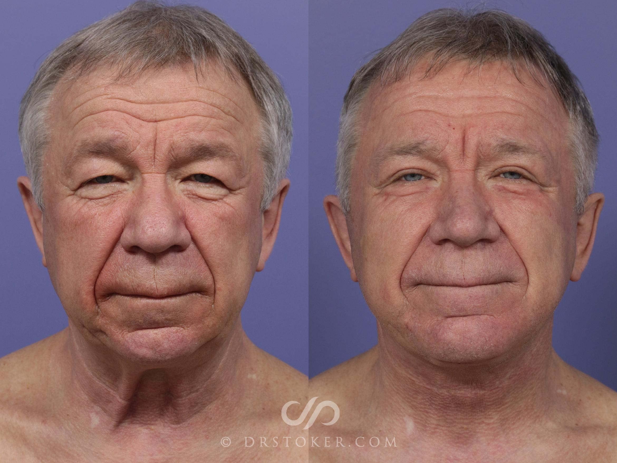 Before & After Cheek/Chin Contouring Case 1161 View #1 View in Marina del Rey, CA