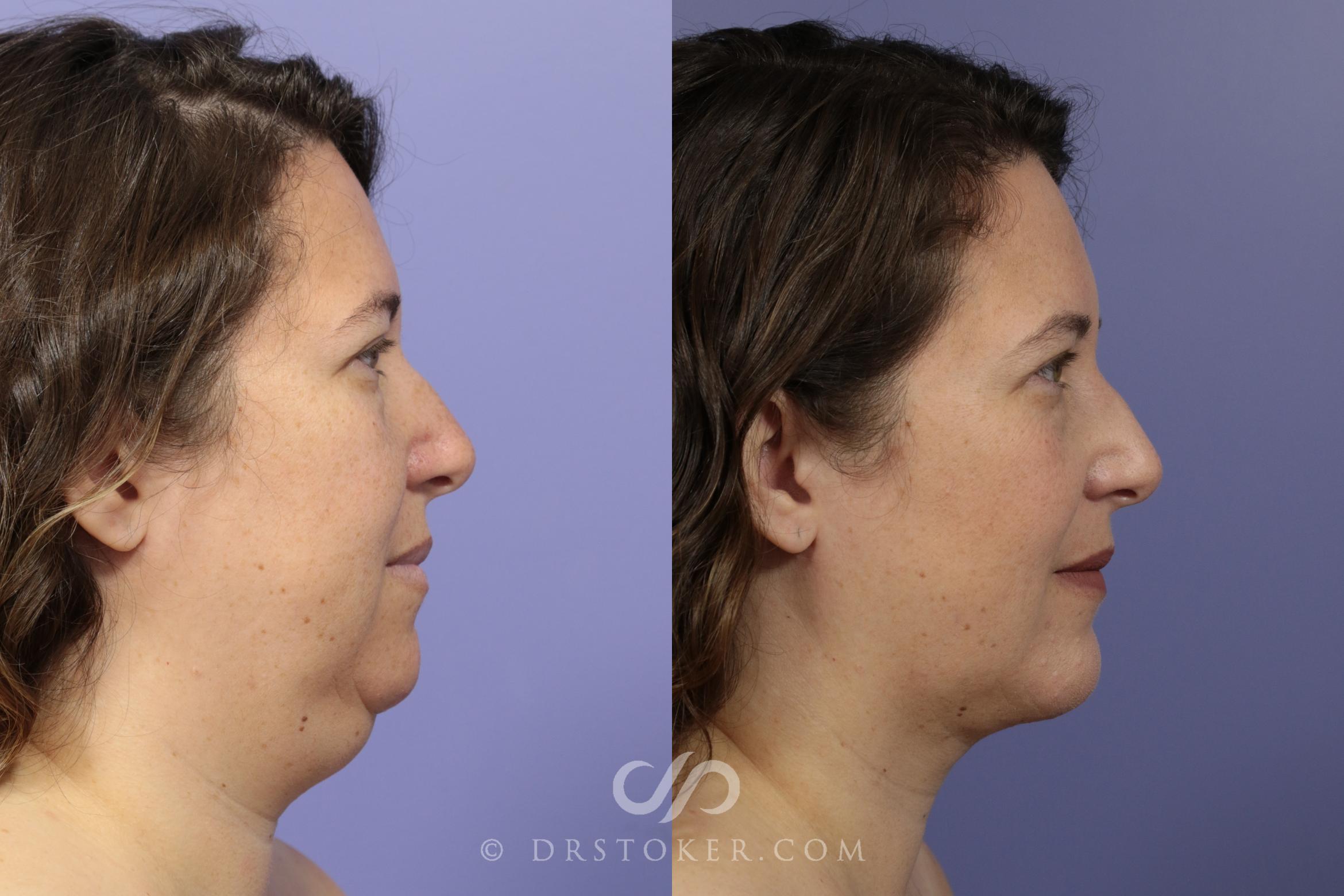 Before & After Chin Augmentation Case 1470 View #1 View in Los Angeles, CA