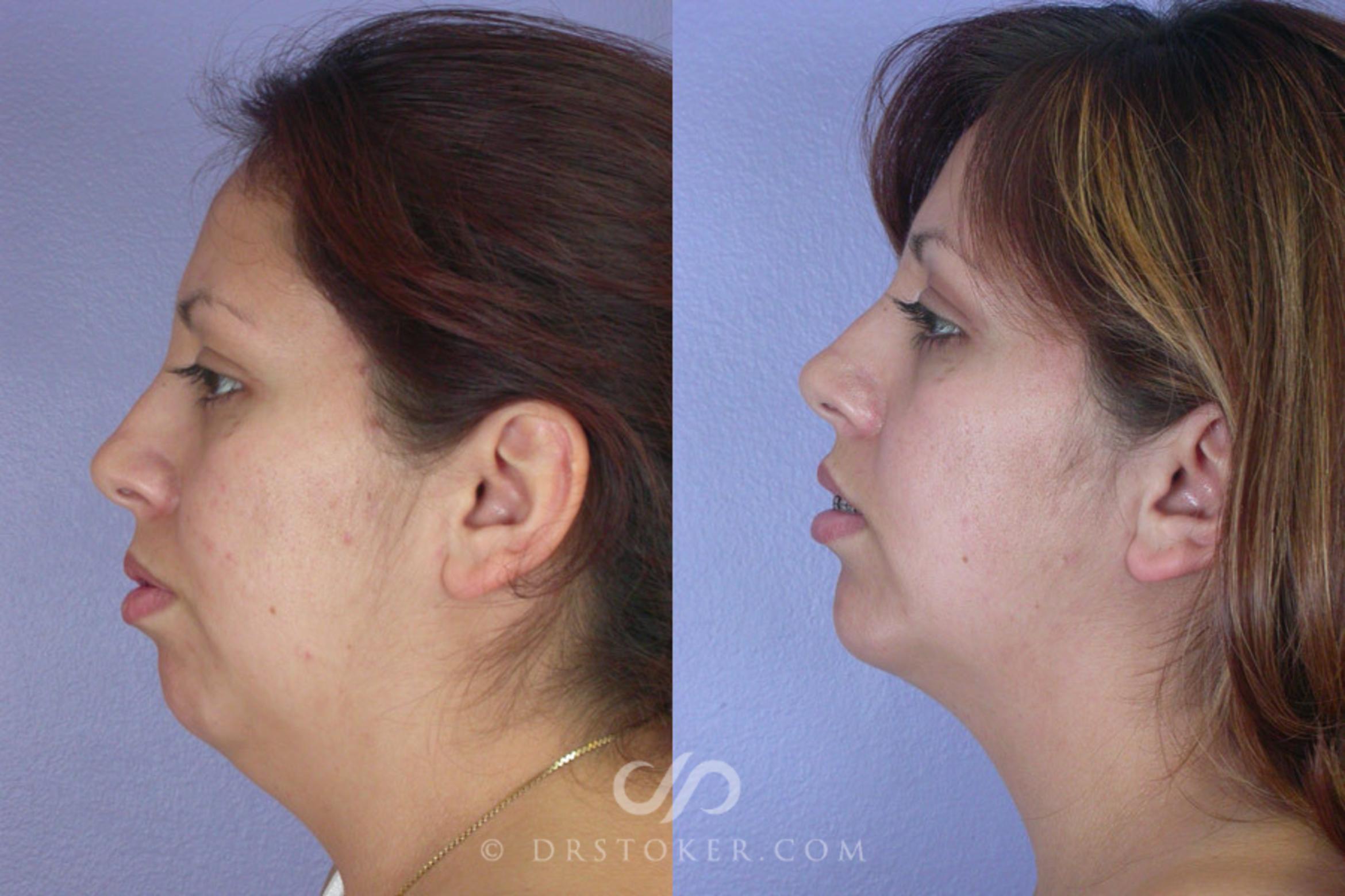 Before & After Chin Augmentation Case 259 View #1 View in Marina del Rey, CA