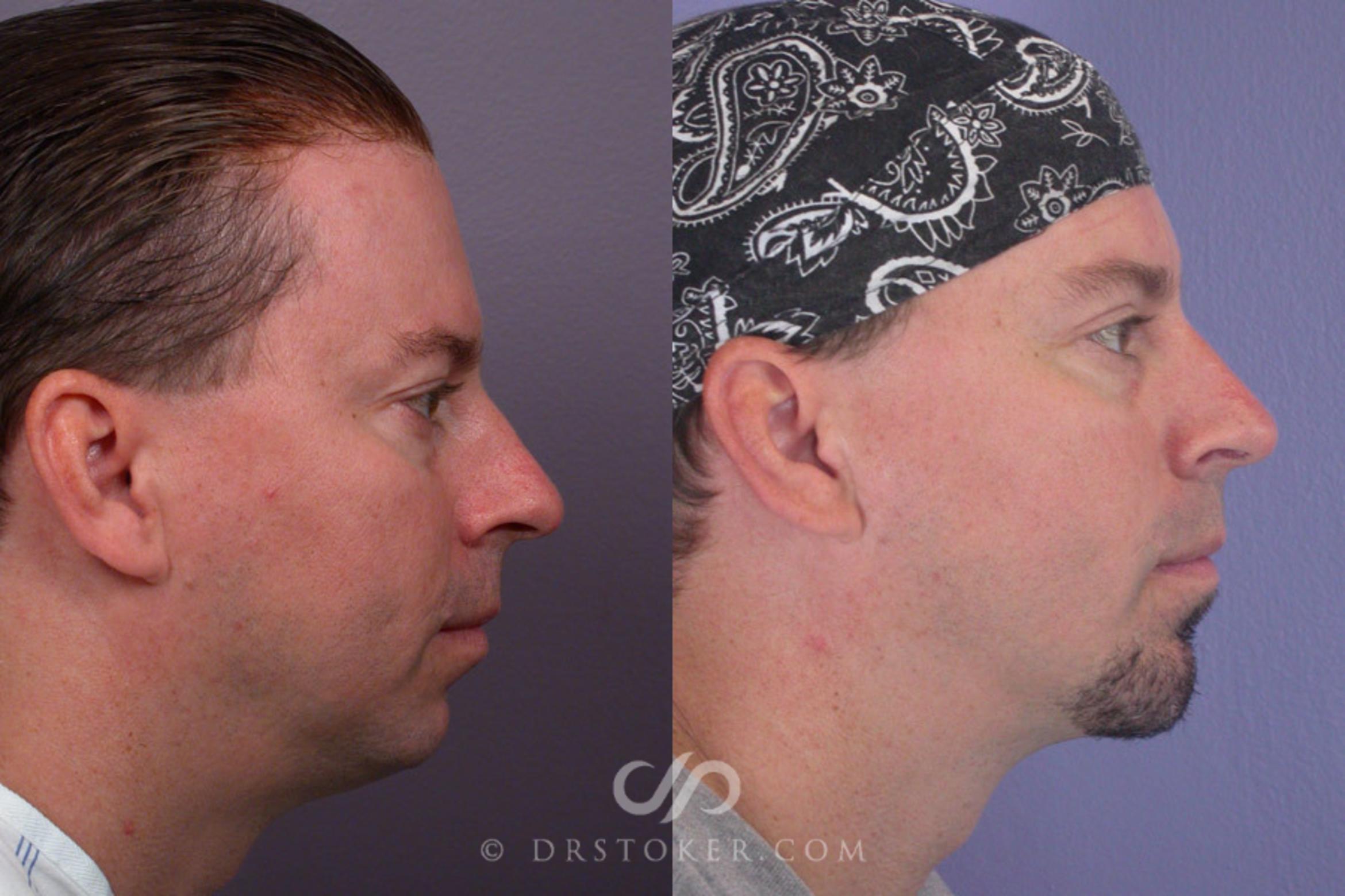 Before & After Liposuction - Neck Case 260 View #1 View in Marina del Rey, CA