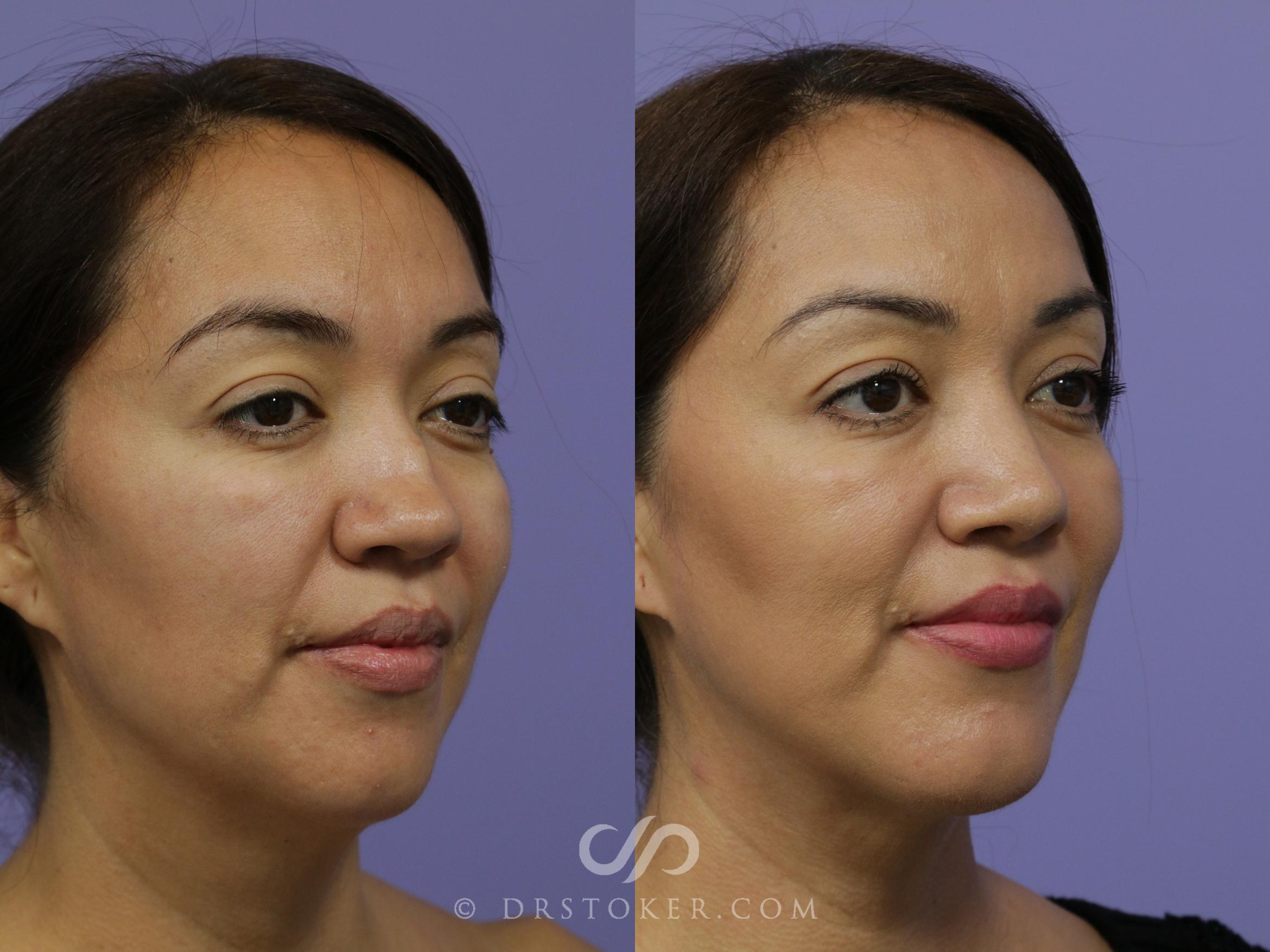 Cheek/Chin Contouring Before and After Pictures Case 888 Los Angeles