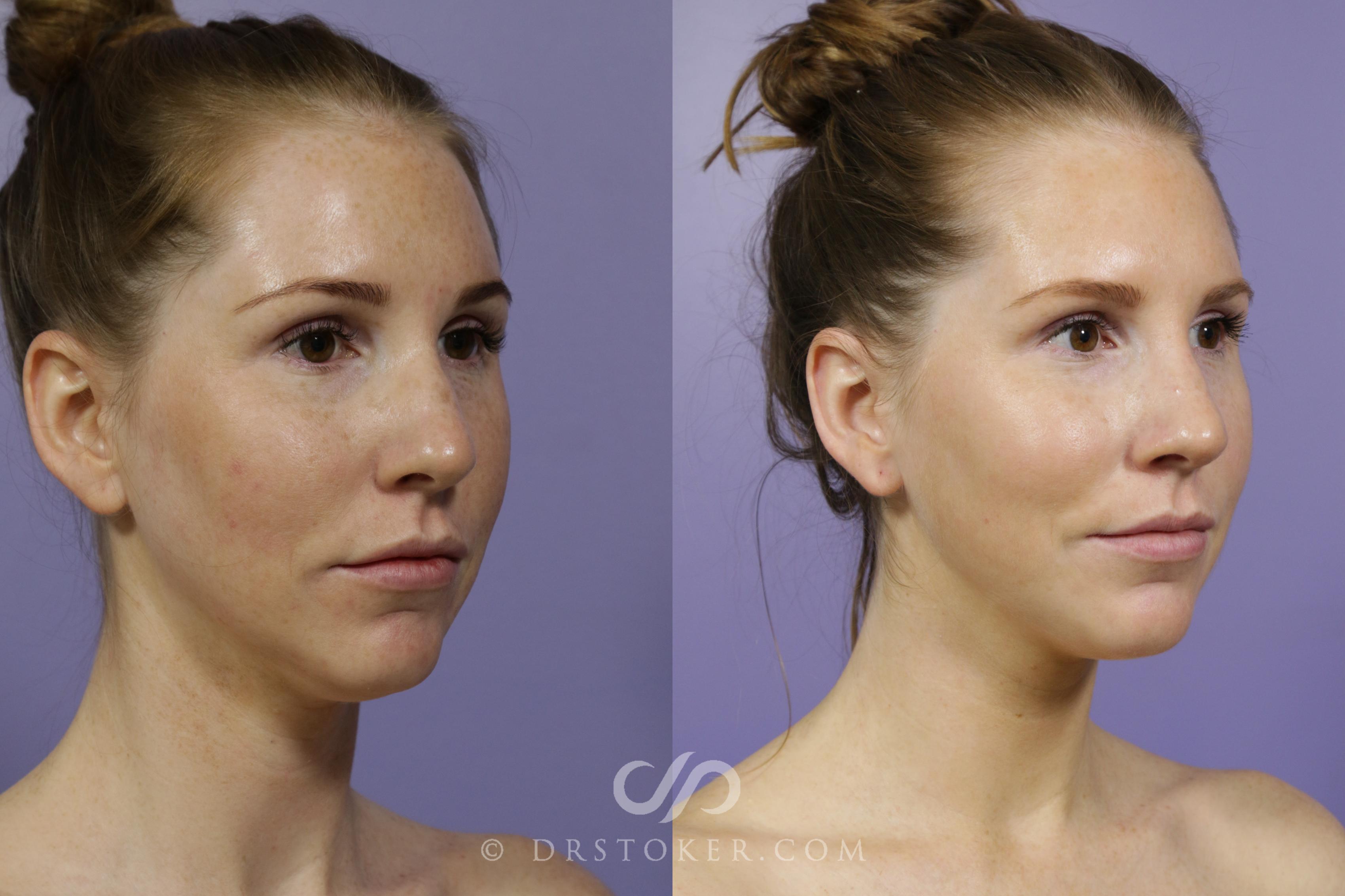 Before & After Chemical Peels Case 1591 View #1 View in Marina del Rey, CA