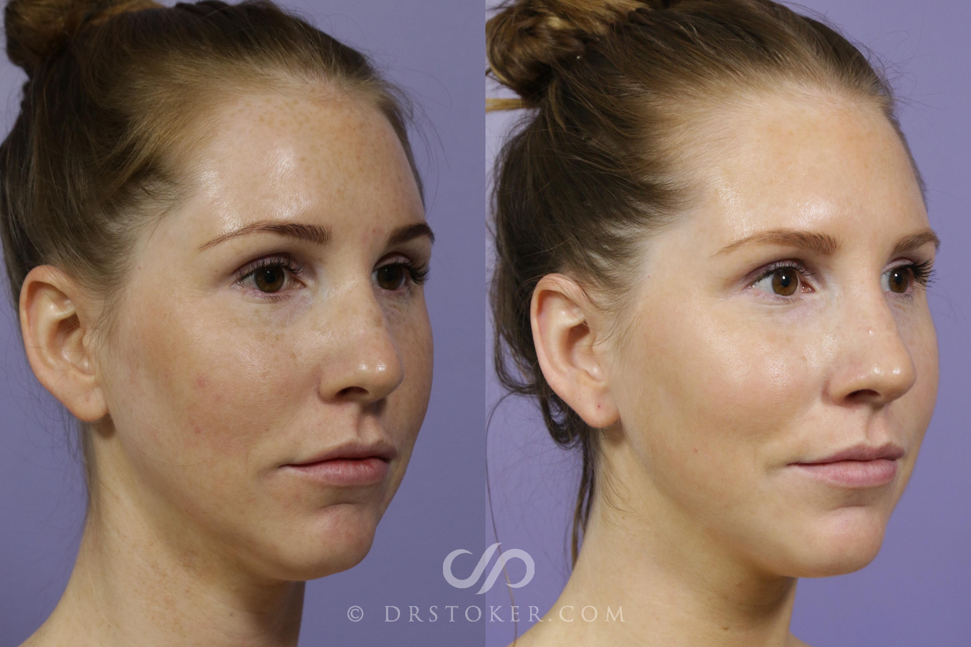 Before & After Chemical Peels Case 1591 View #1 View in Los Angeles, CA