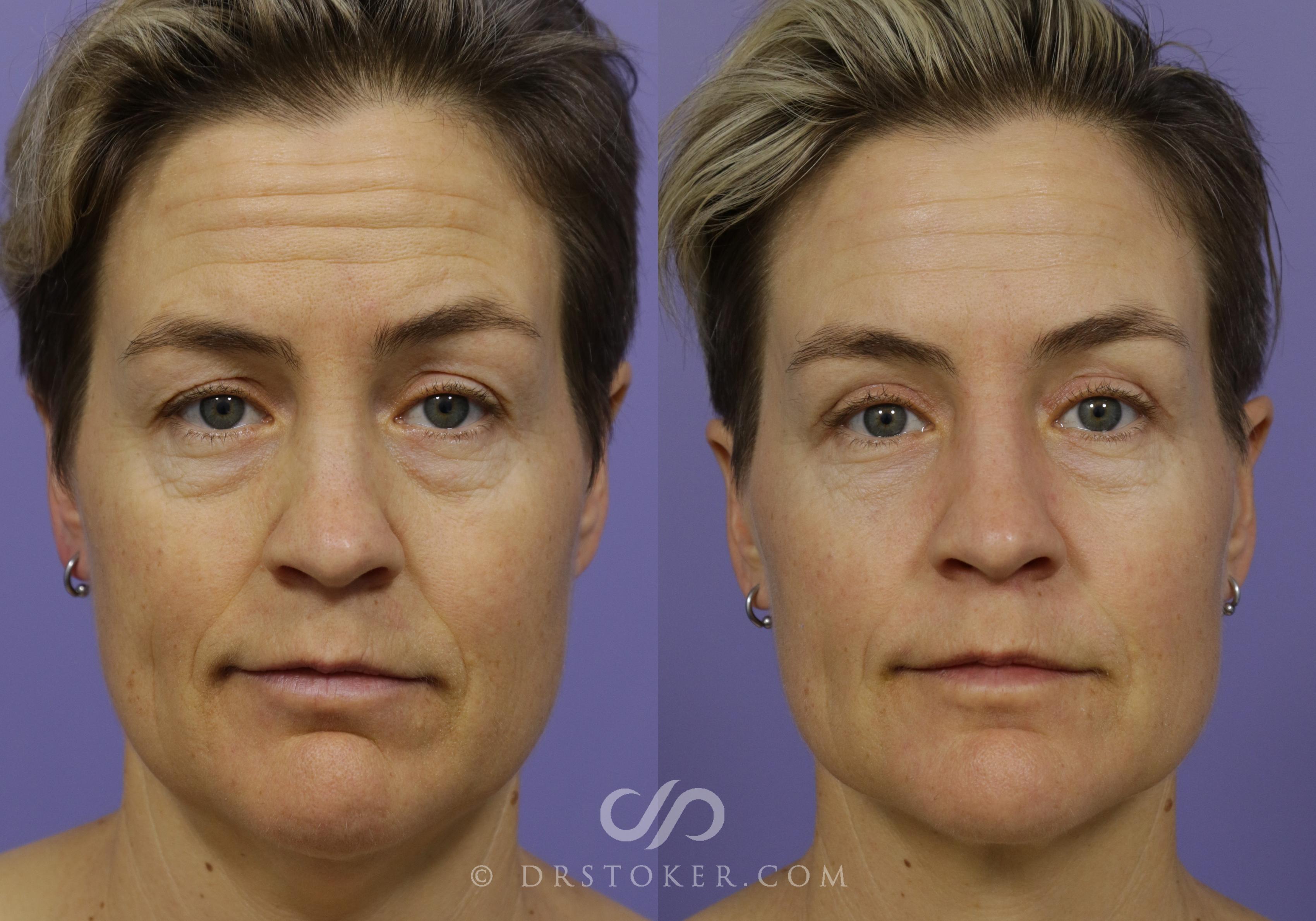 Before & After Chemical Peels Case 1614 View #1 View in Marina del Rey, CA
