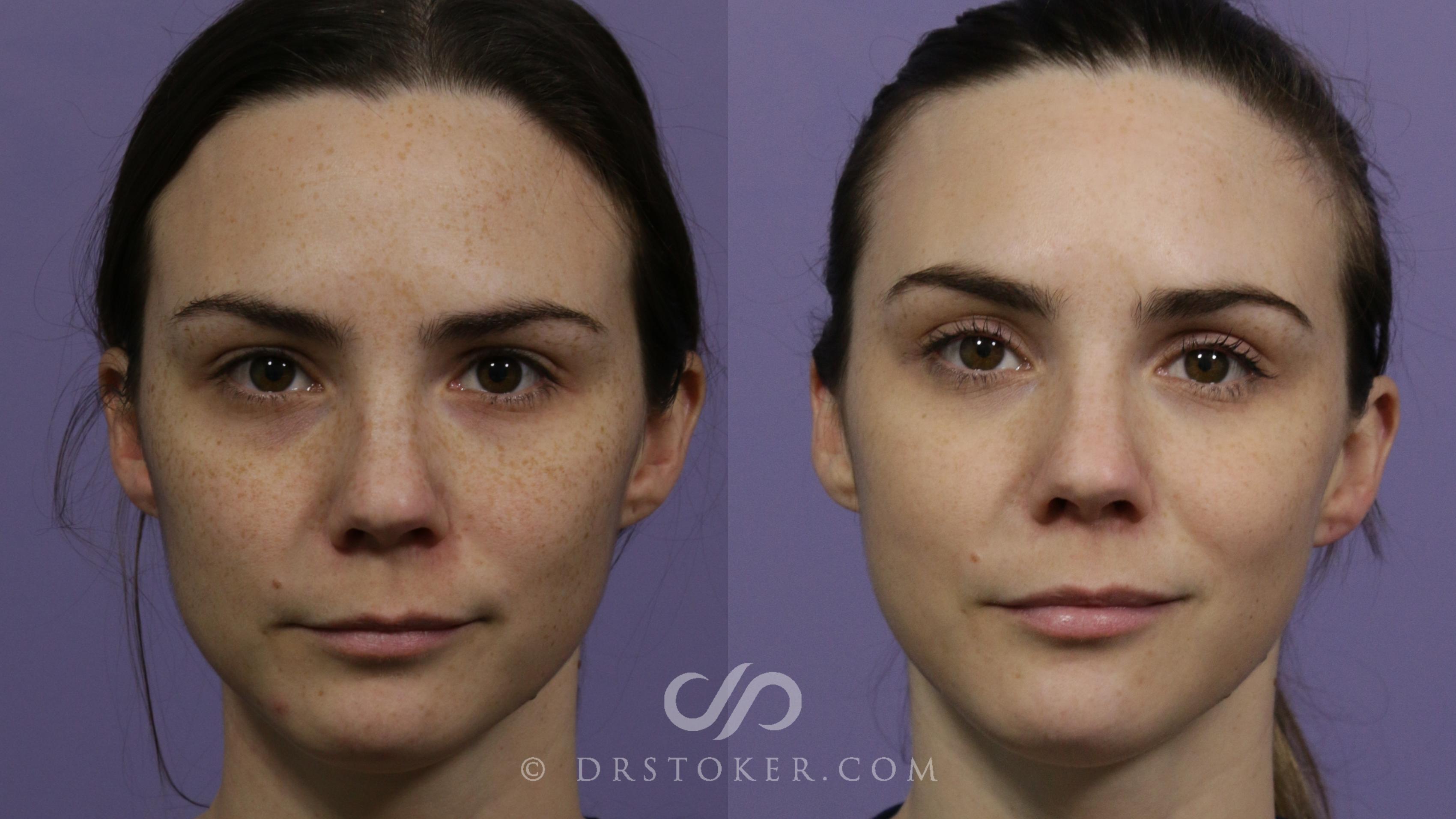Before & After Chemical Peels Case 1886 Front View in Marina del Rey, CA