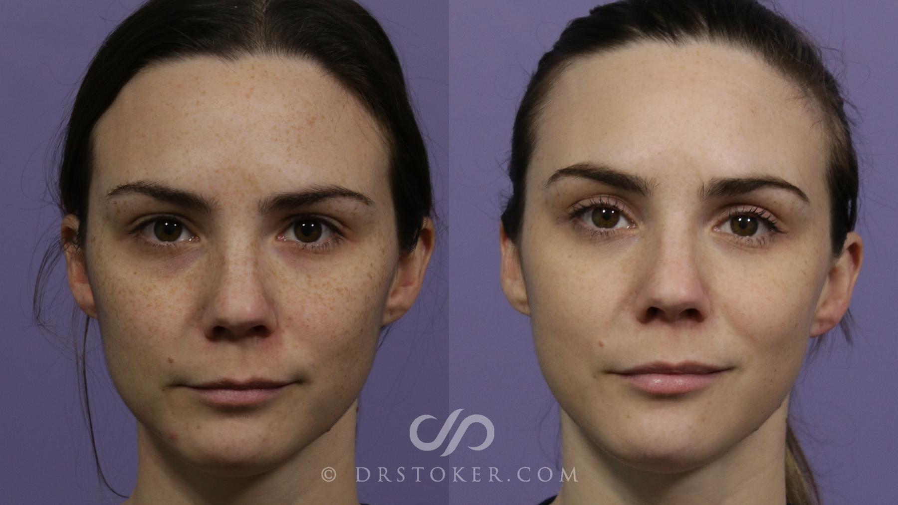 Before & After Chemical Peels Case 1886 Front View in Los Angeles, CA