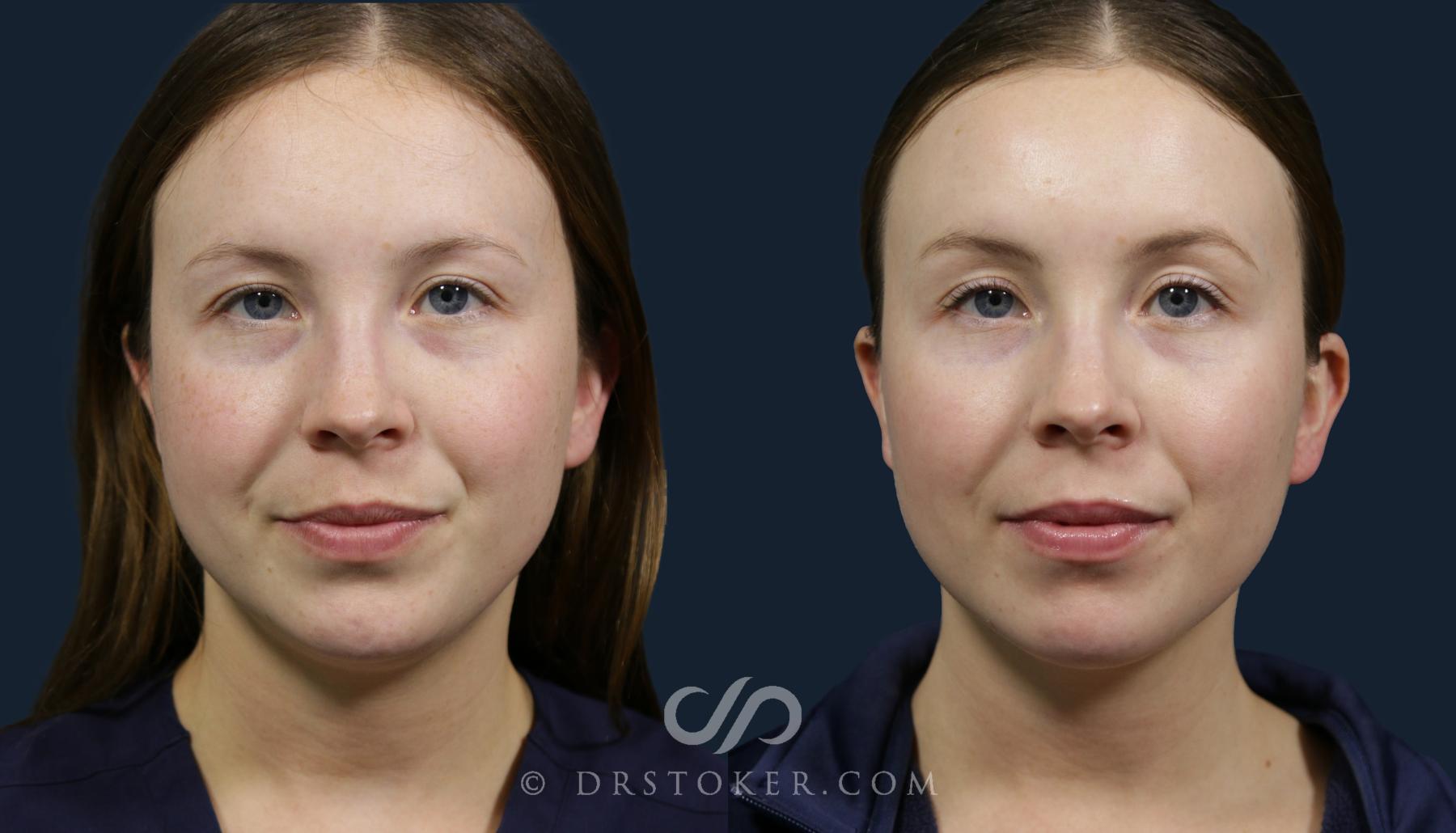 Before & After Chemical Peels Case 2144 Front View in Los Angeles, CA