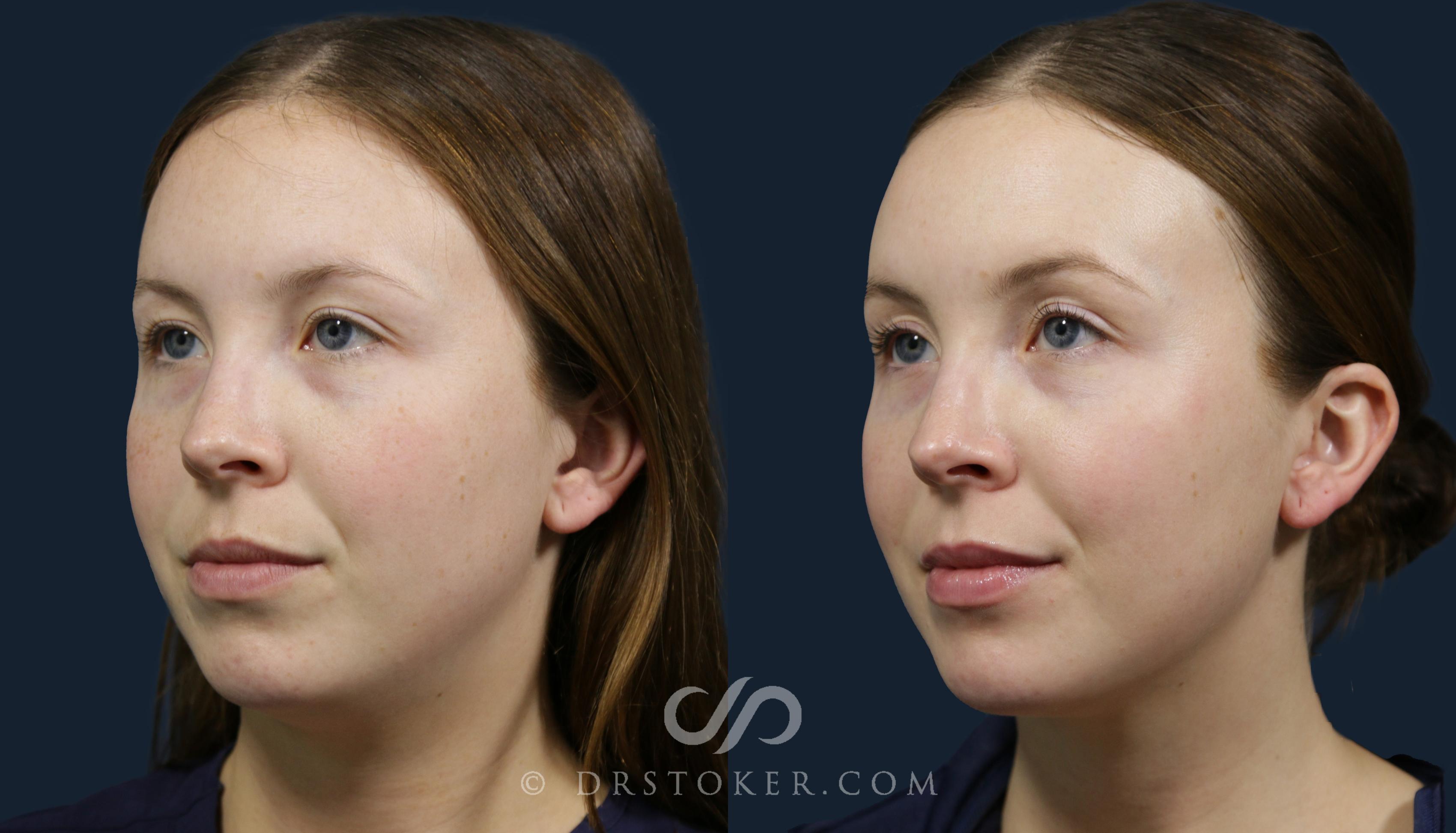 Before & After Skin Rejuvenation Treatments Case 2144 Left Oblique View in Los Angeles, CA