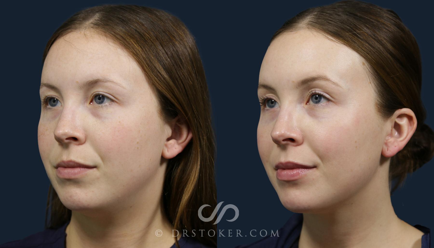 Before & After Chemical Peels Case 2144 Left Oblique View in Los Angeles, CA