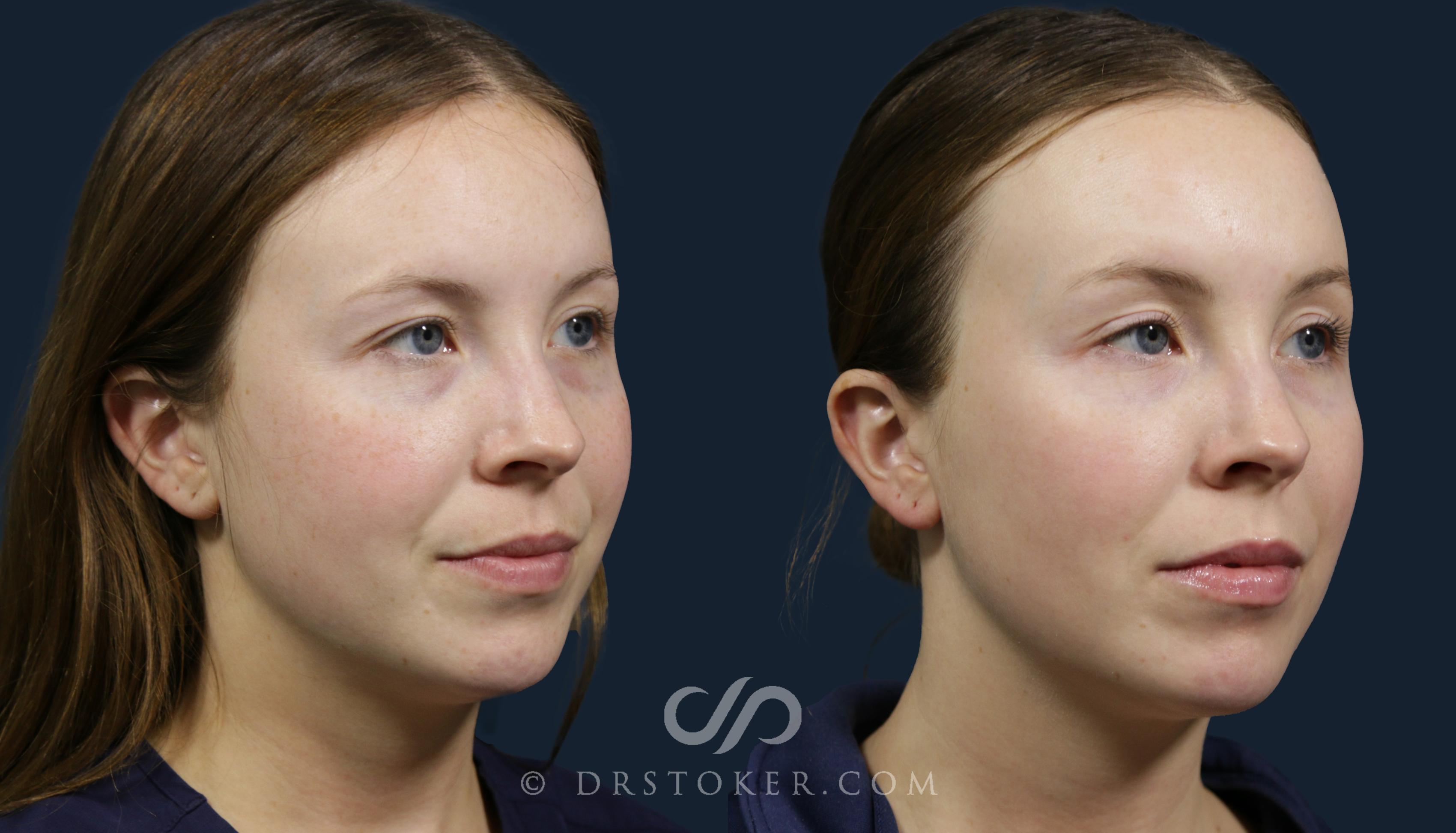 Before & After Skin Rejuvenation Treatments Case 2144 Right Oblique View in Los Angeles, CA