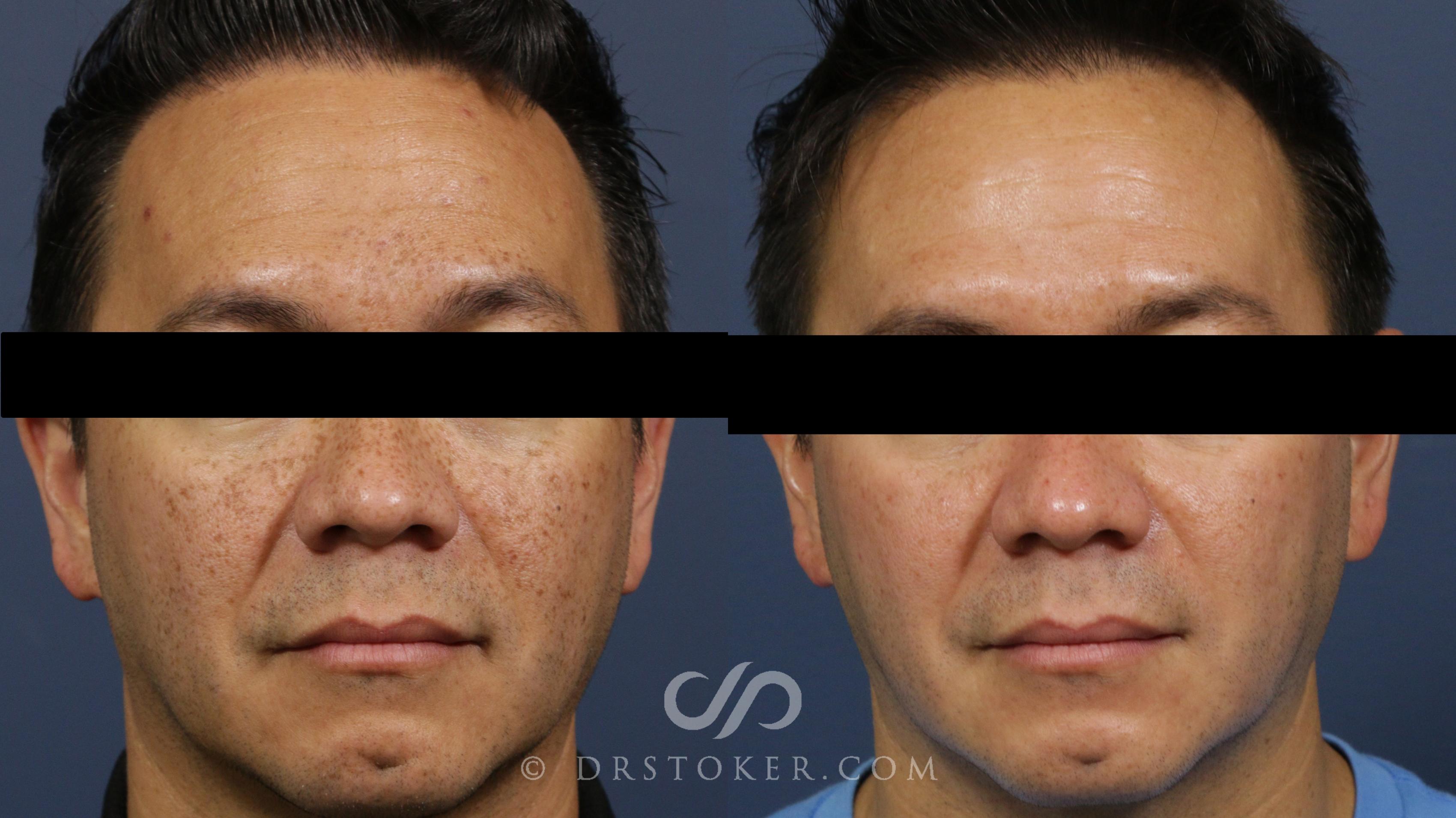 Before & After Chemical Peels Case 2261 Front View in Los Angeles, CA