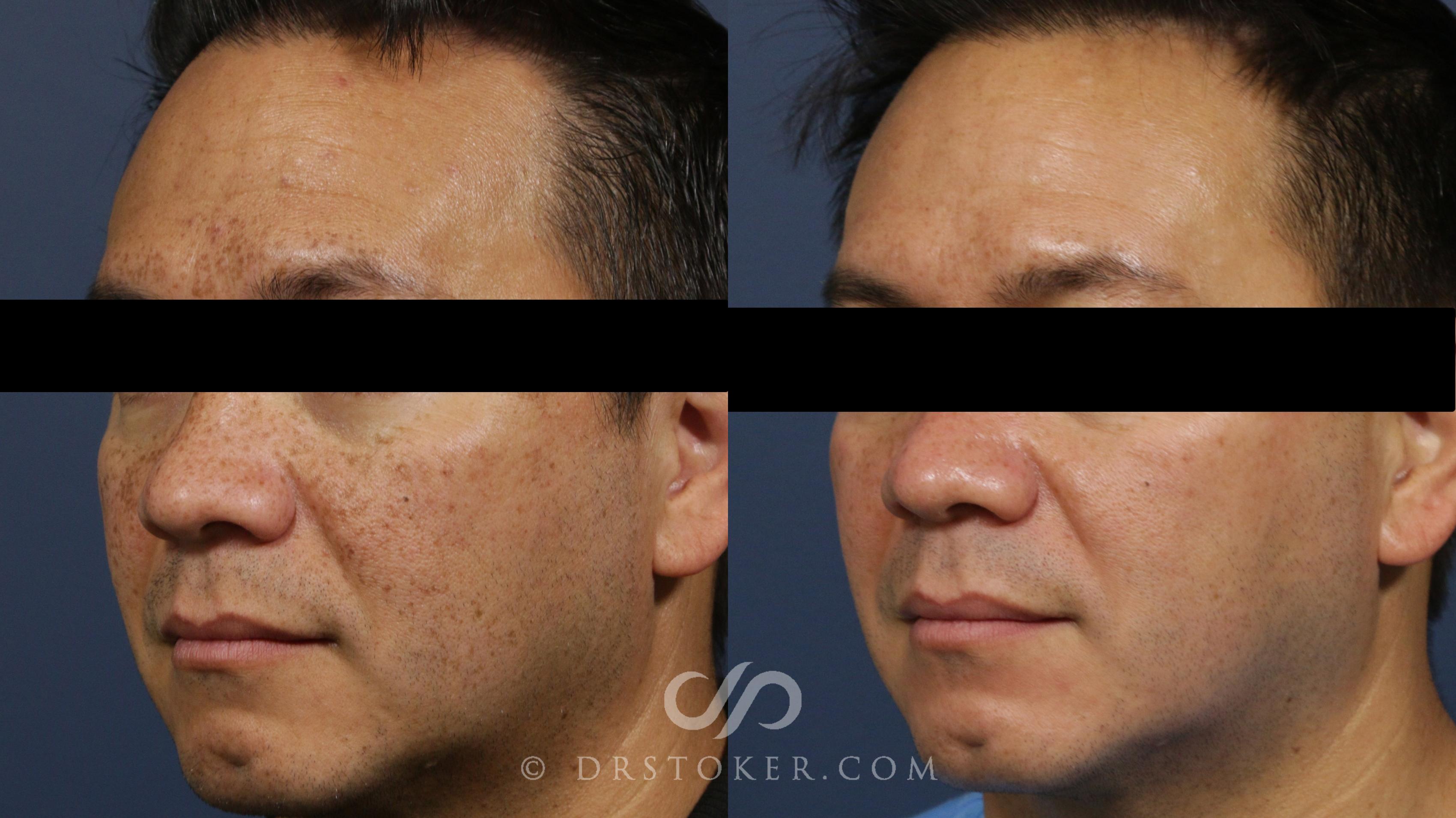 Before & After Chemical Peels Case 2262 Left Oblique View in Los Angeles, CA