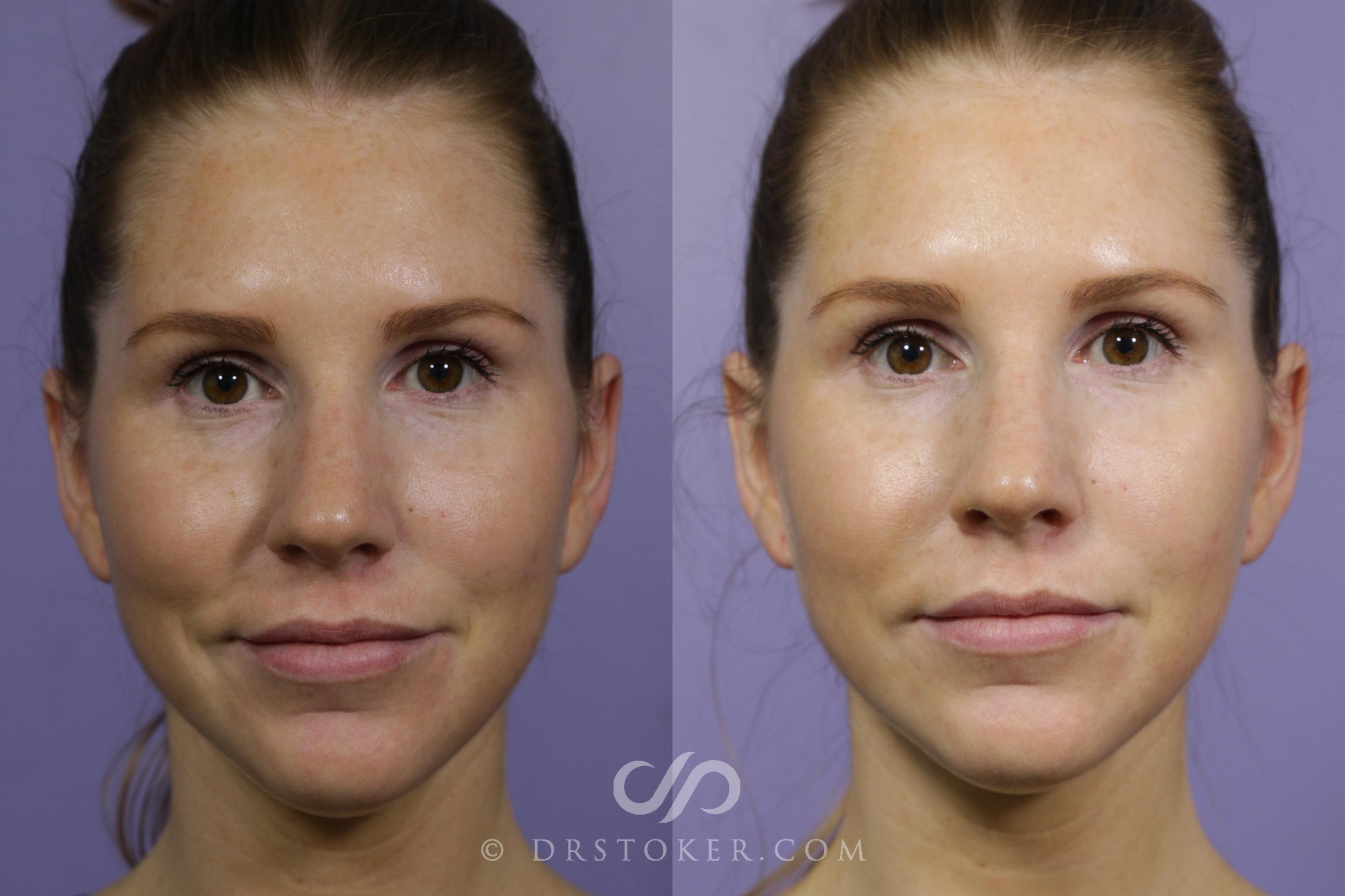 Before & After Skin Rejuvenation Treatments Case 2287 Front View in Los Angeles, CA