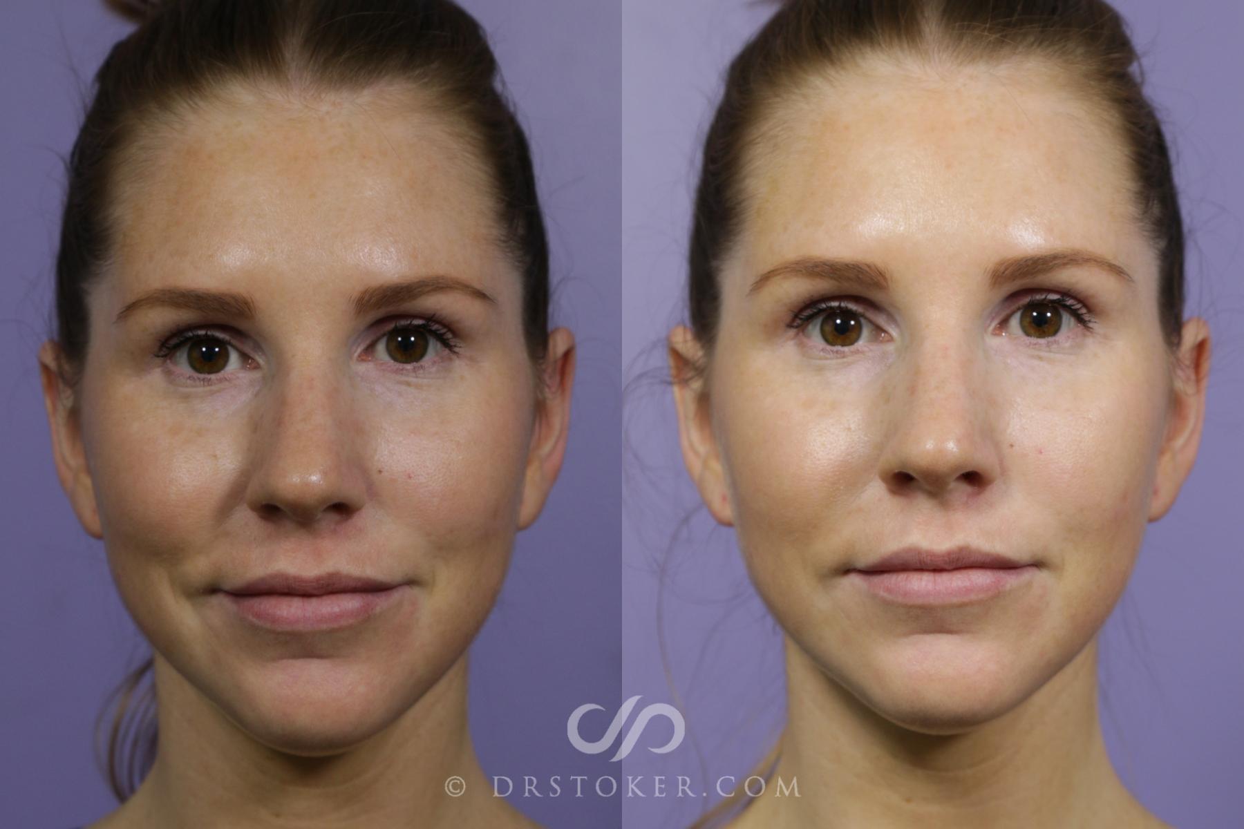 Before & After Chemical Peels Case 2287 Front View in Los Angeles, CA