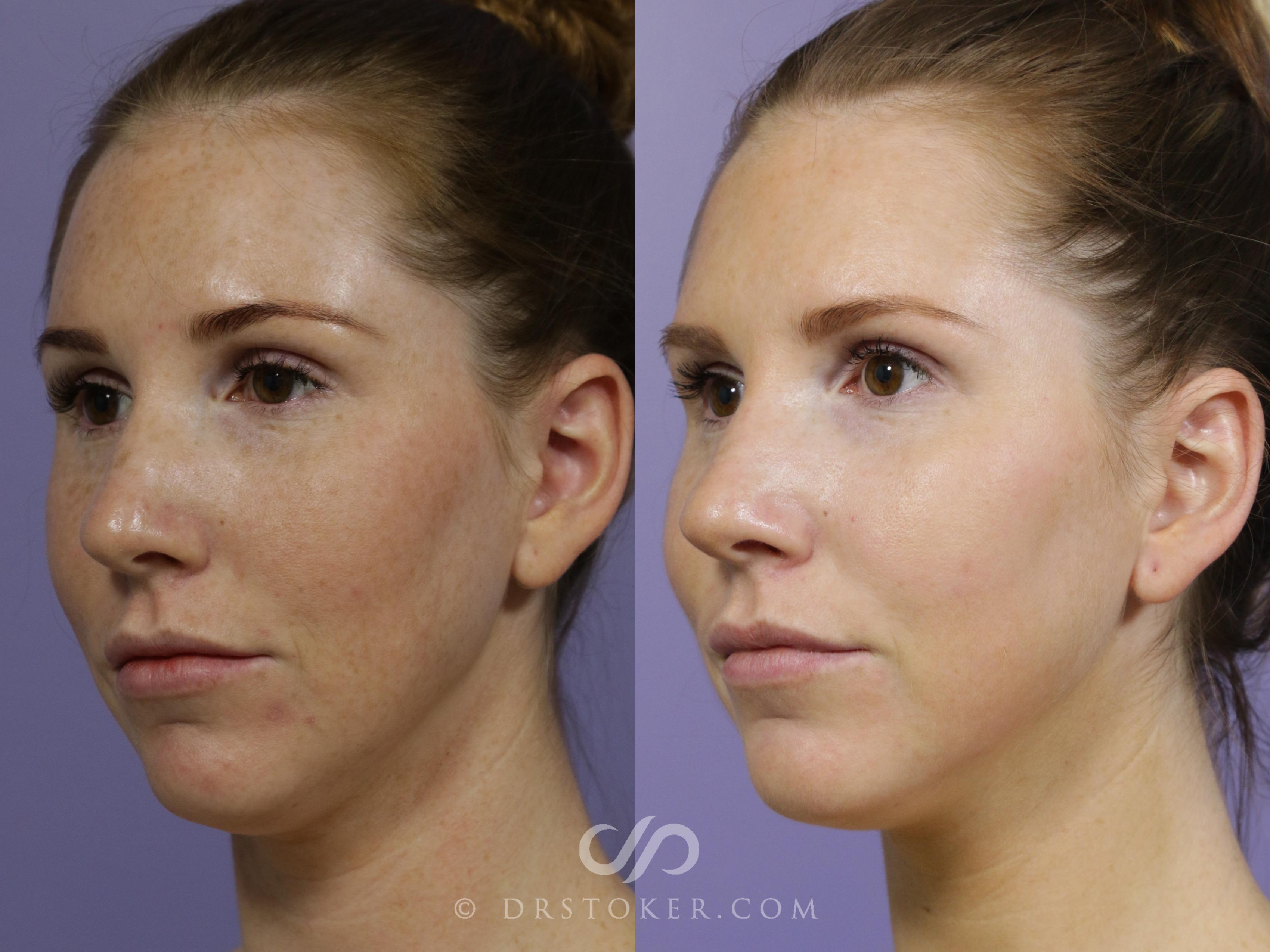 Before & After Chemical Peels Case 2288 Left Oblique View in Los Angeles, CA